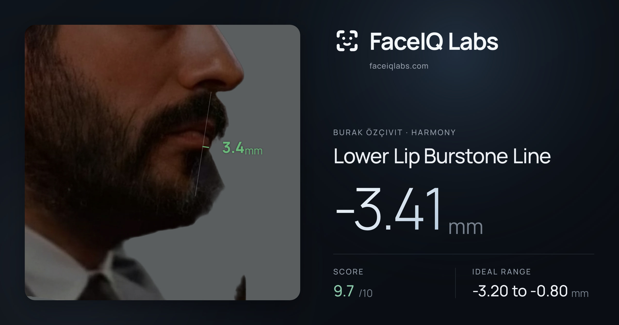 Burak Özçivit Lower Lip Burstone Line: -3.41mm, drawn on the photo