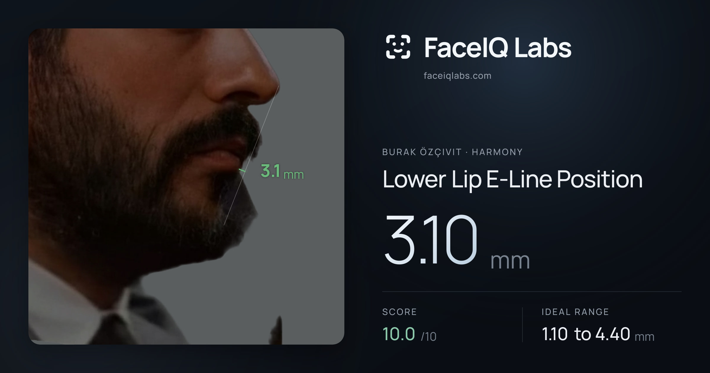 Burak Özçivit Lower Lip E-Line Position: 3.10mm, drawn on the photo