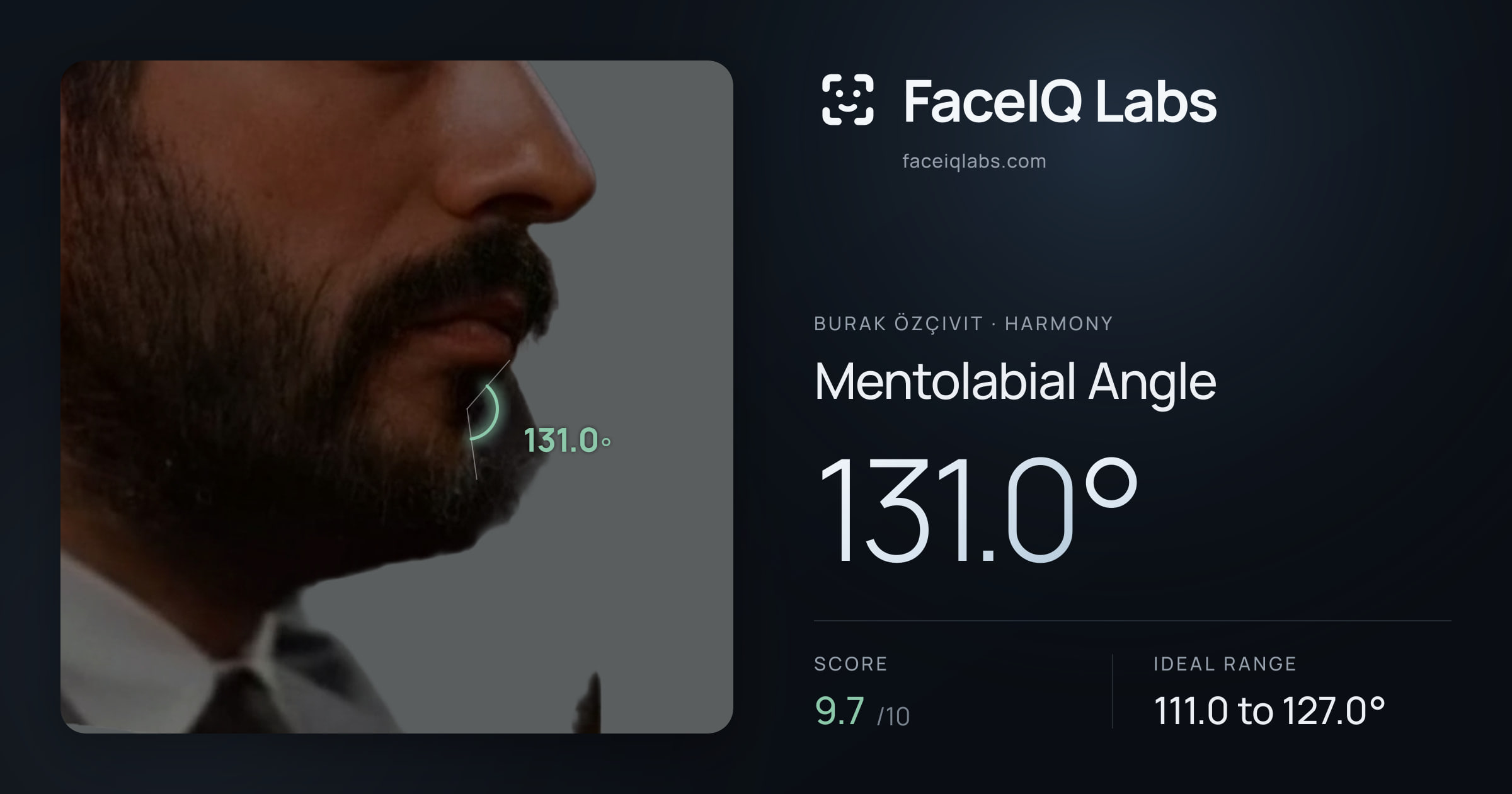 Burak Özçivit Mentolabial Angle: 131.0°, drawn on the photo