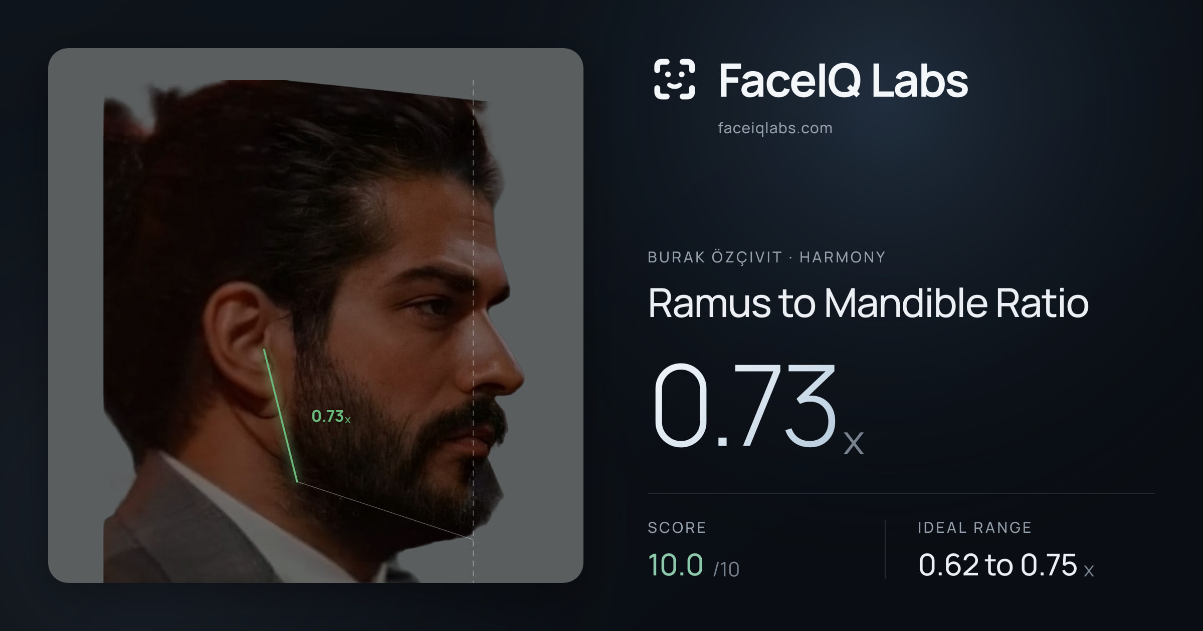 Burak Özçivit Ramus to Mandible Ratio: 0.73x, drawn on the photo