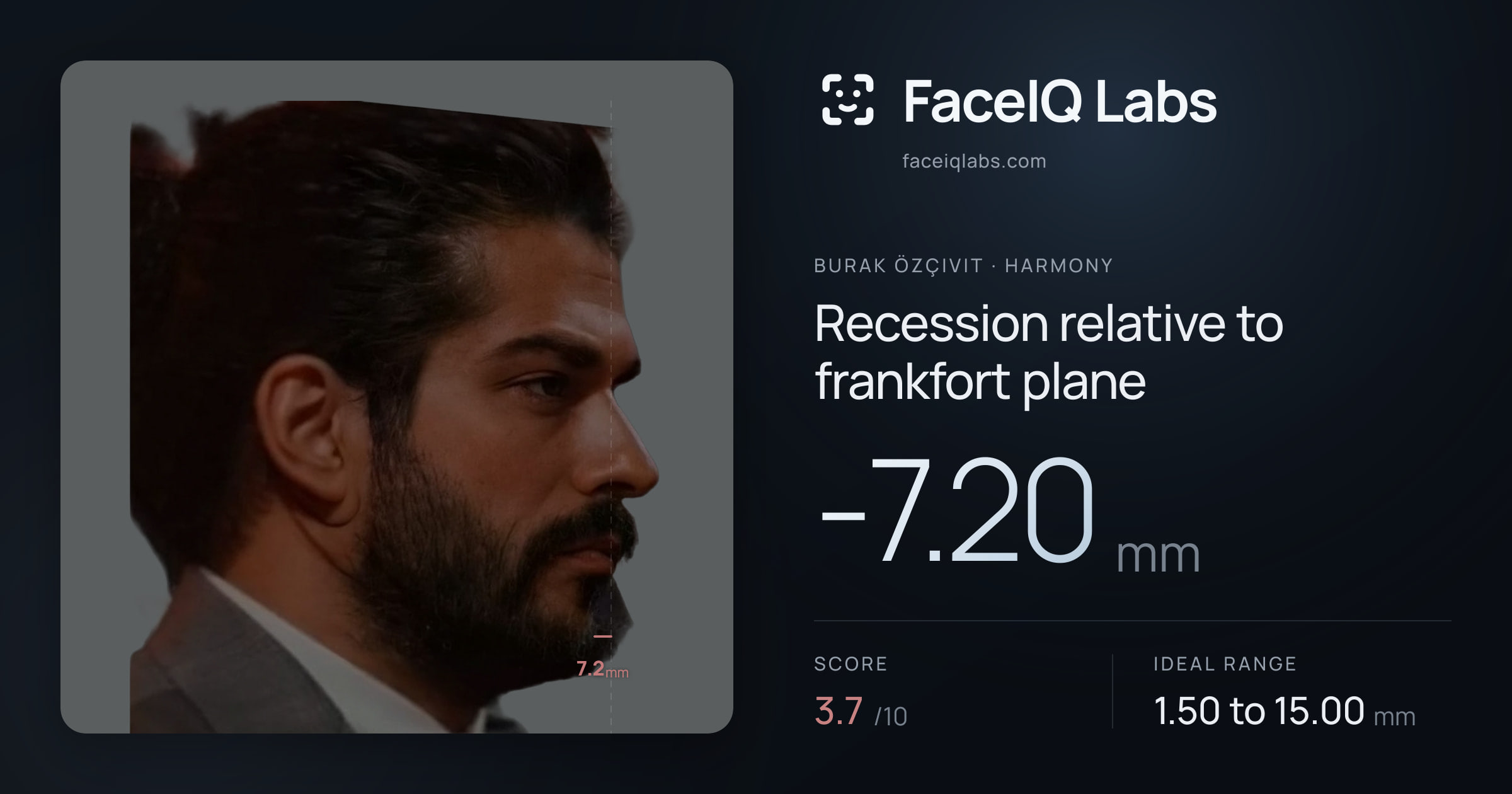 Burak Özçivit Recession relative to frankfort plane: -7.20mm, drawn on the photo