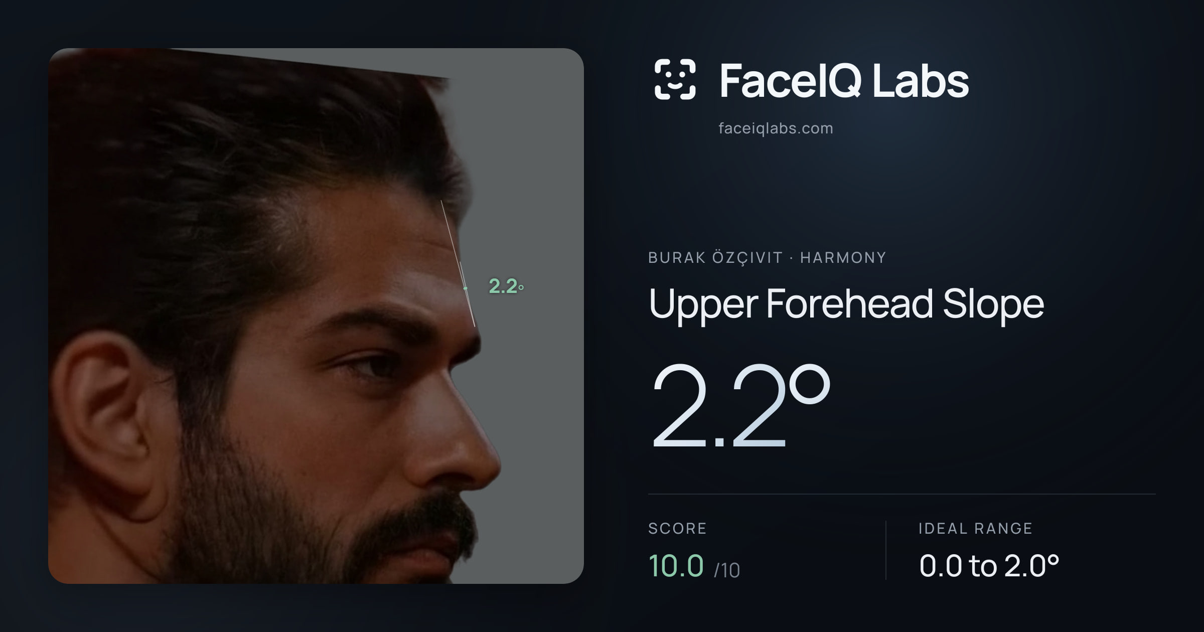 Burak Özçivit Upper Forehead Slope: 2.2°, drawn on the photo