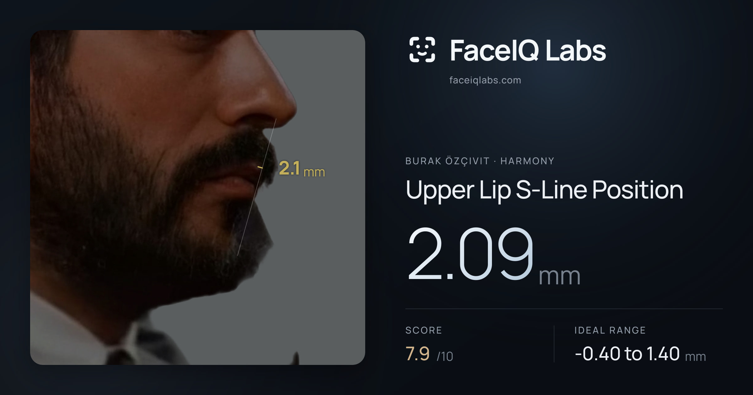 Burak Özçivit Upper Lip S-Line Position: 2.09mm, drawn on the photo