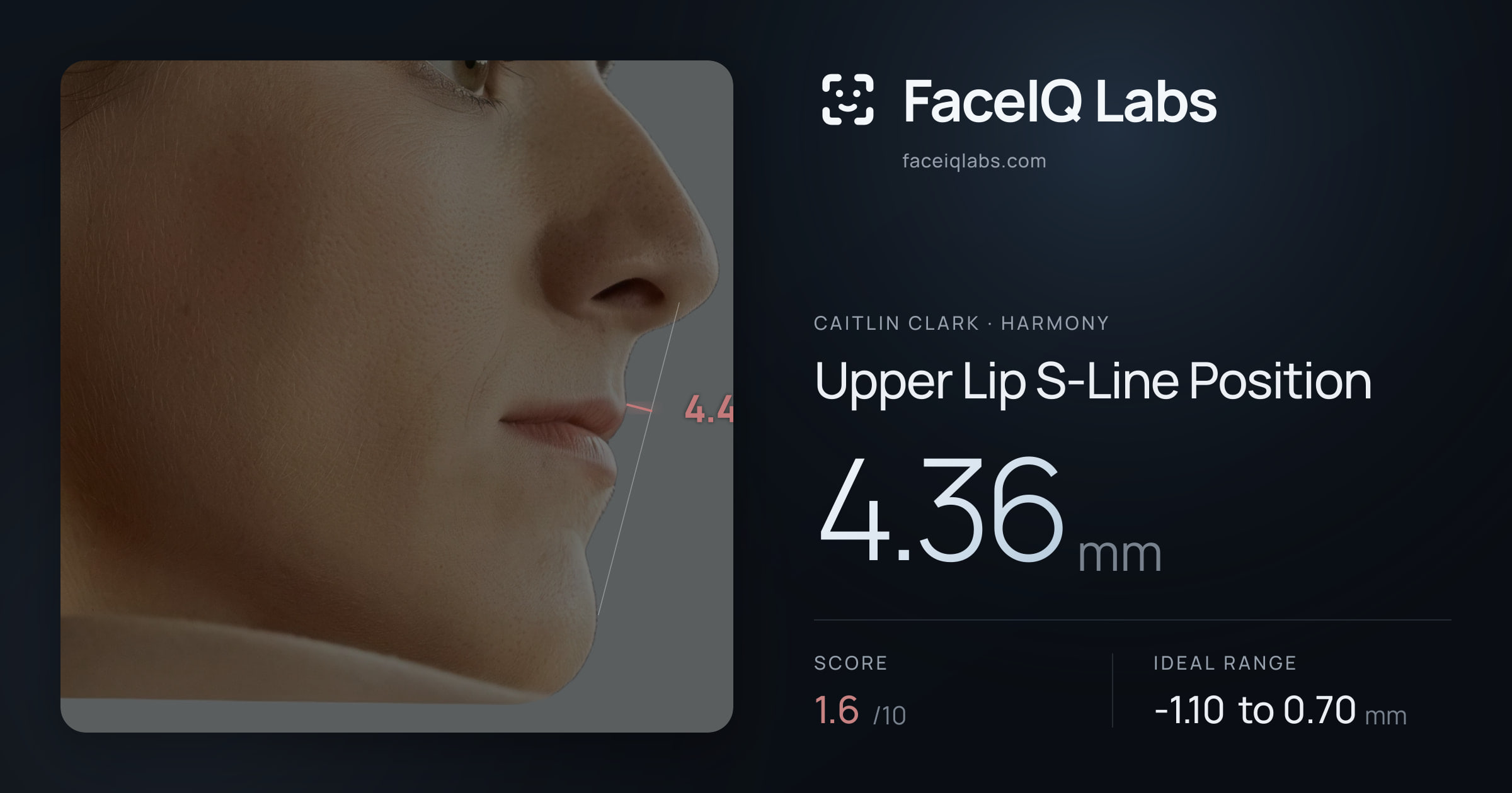 Caitlin Clark Upper Lip S-Line Position: 4.36mm, drawn on the photo