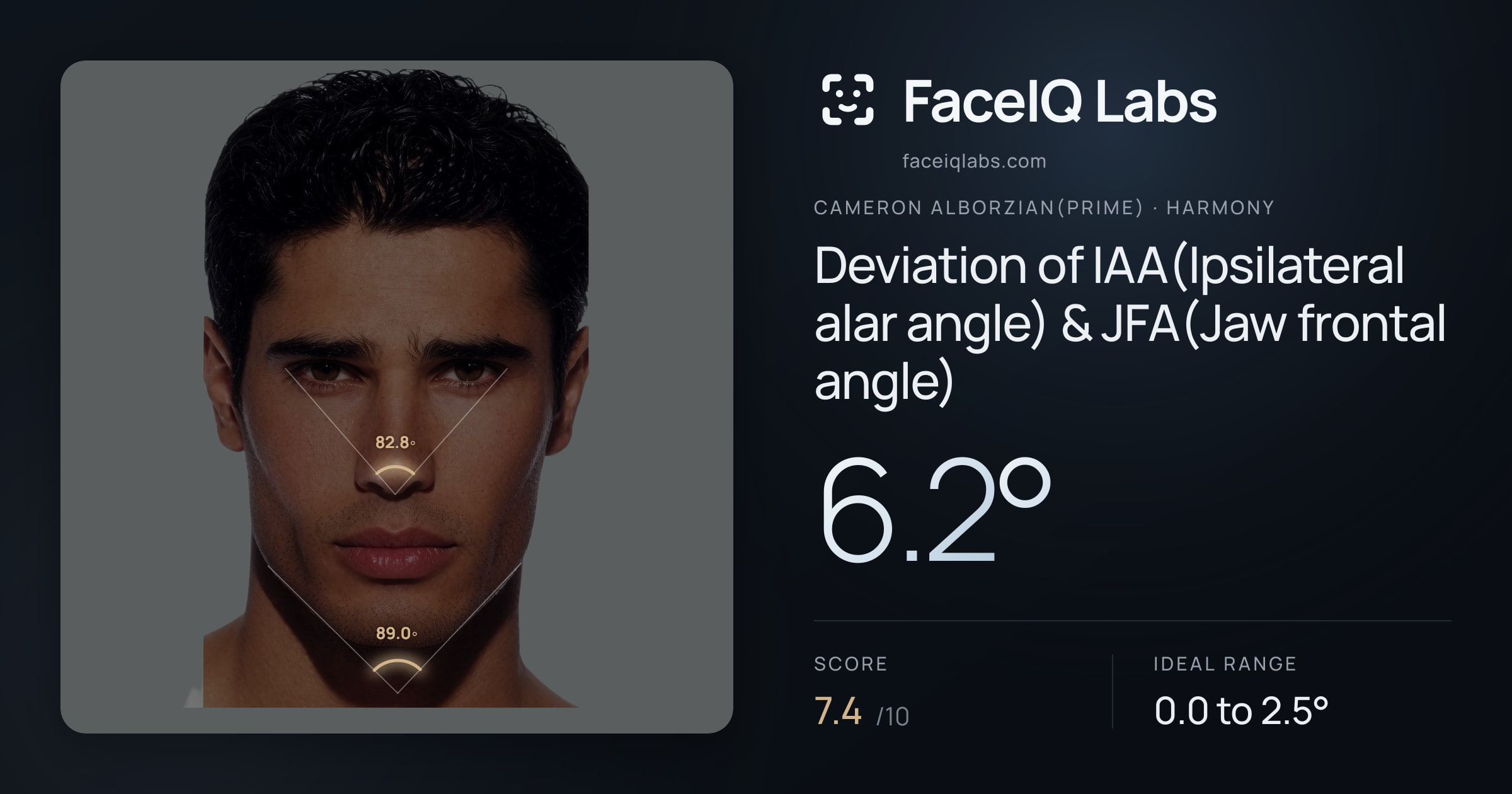 Cameron Alborzian(Prime) Deviation of IAA(Ipsilateral alar angle) & JFA(Jaw frontal angle): 6.2°, drawn on the photo