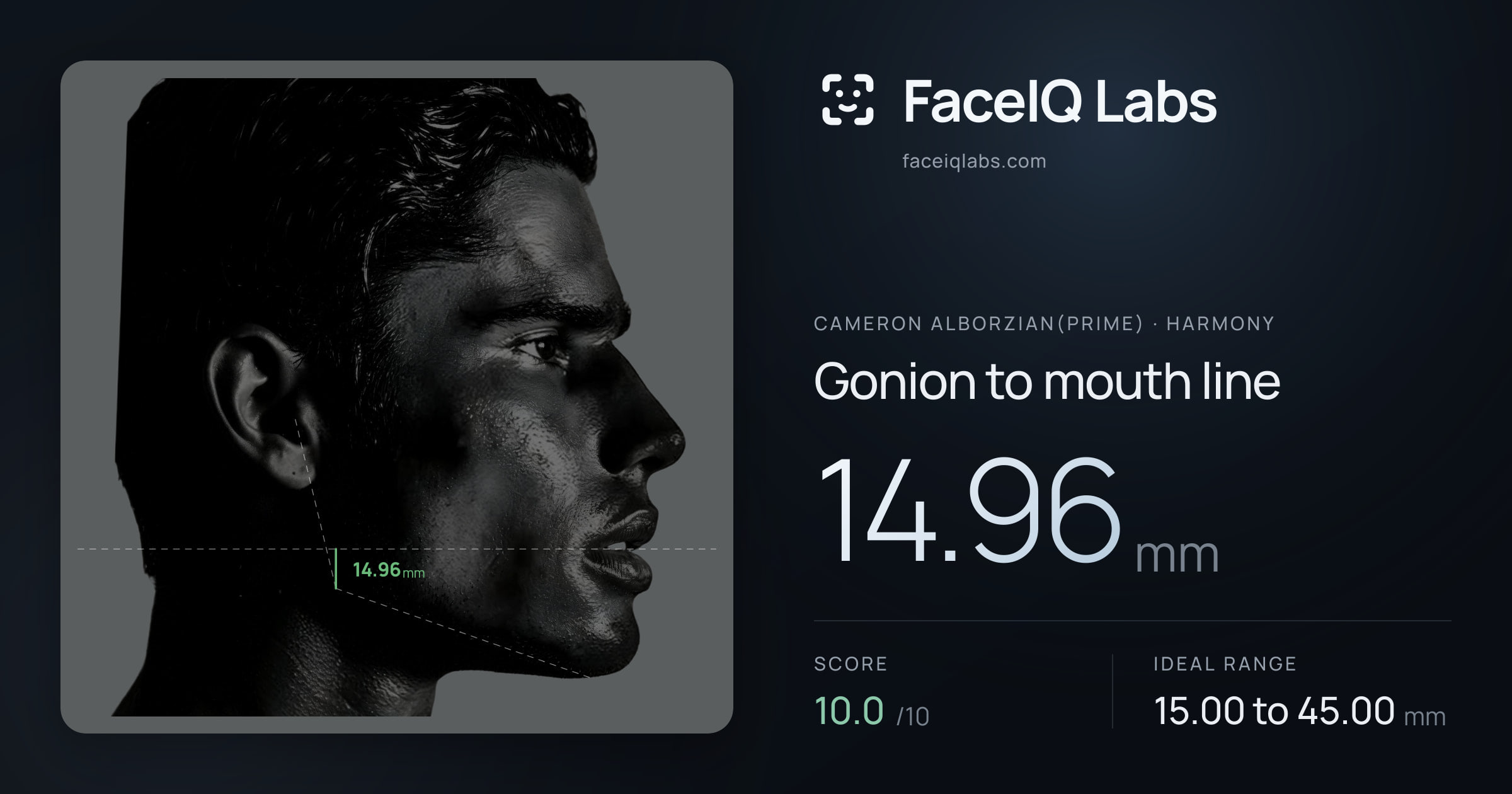 Cameron Alborzian(Prime) Gonion to mouth line: 14.96mm, drawn on the photo