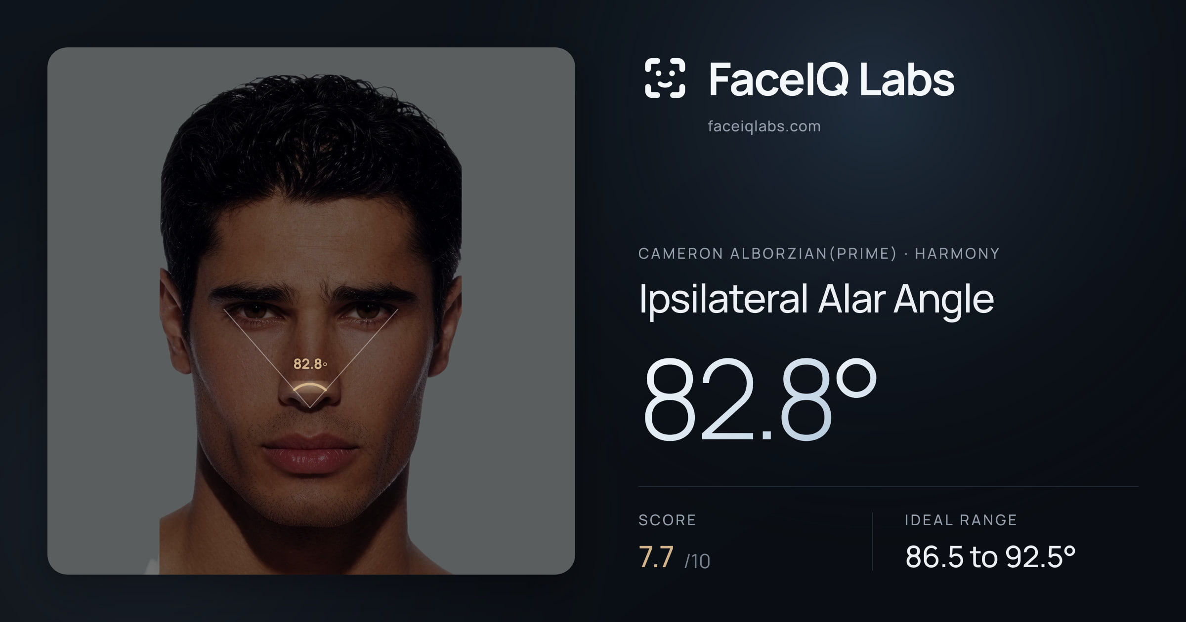 Cameron Alborzian(Prime) Ipsilateral Alar Angle: 82.8°, drawn on the photo