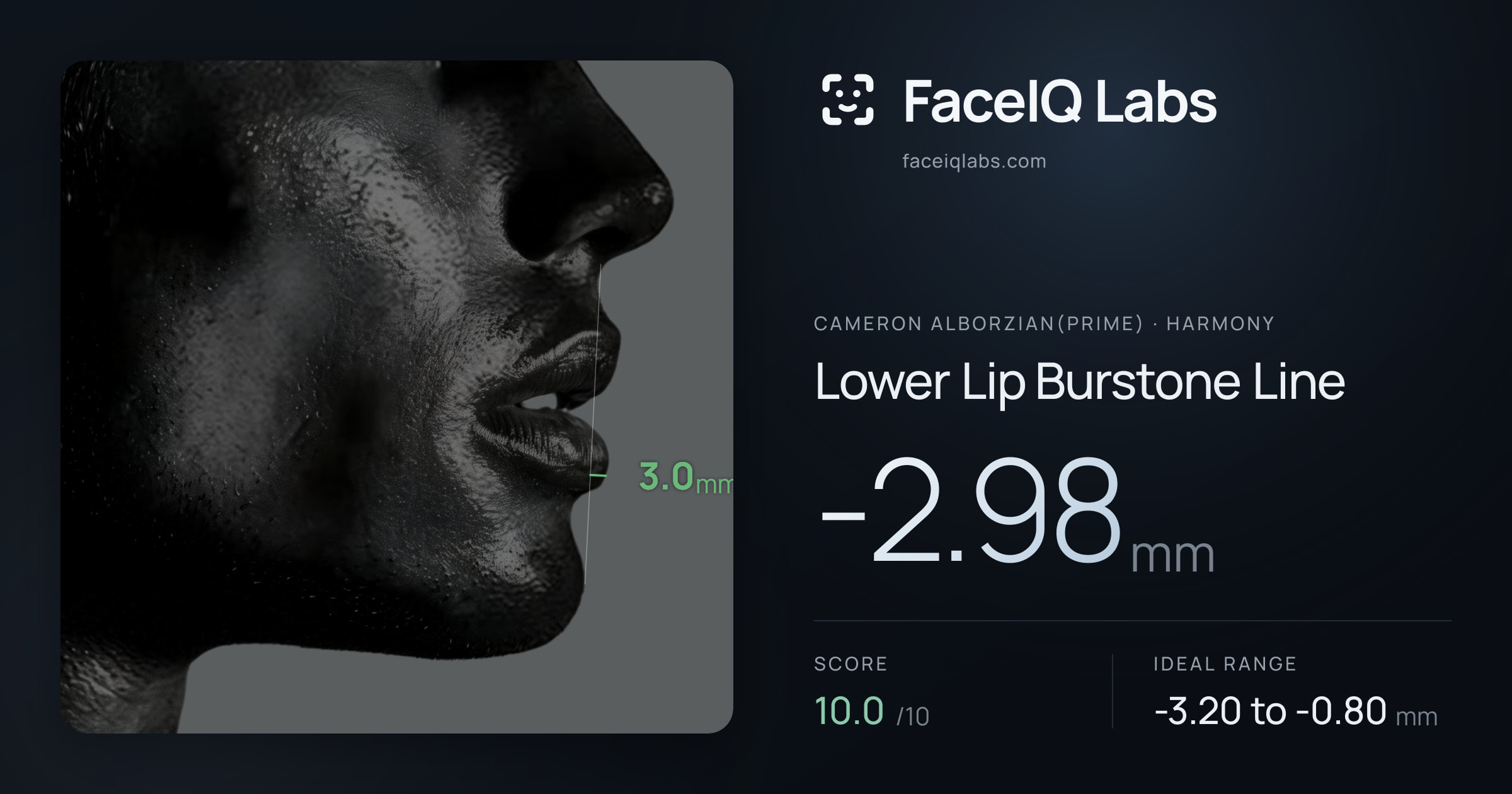 Cameron Alborzian(Prime) Lower Lip Burstone Line: -2.98mm, drawn on the photo