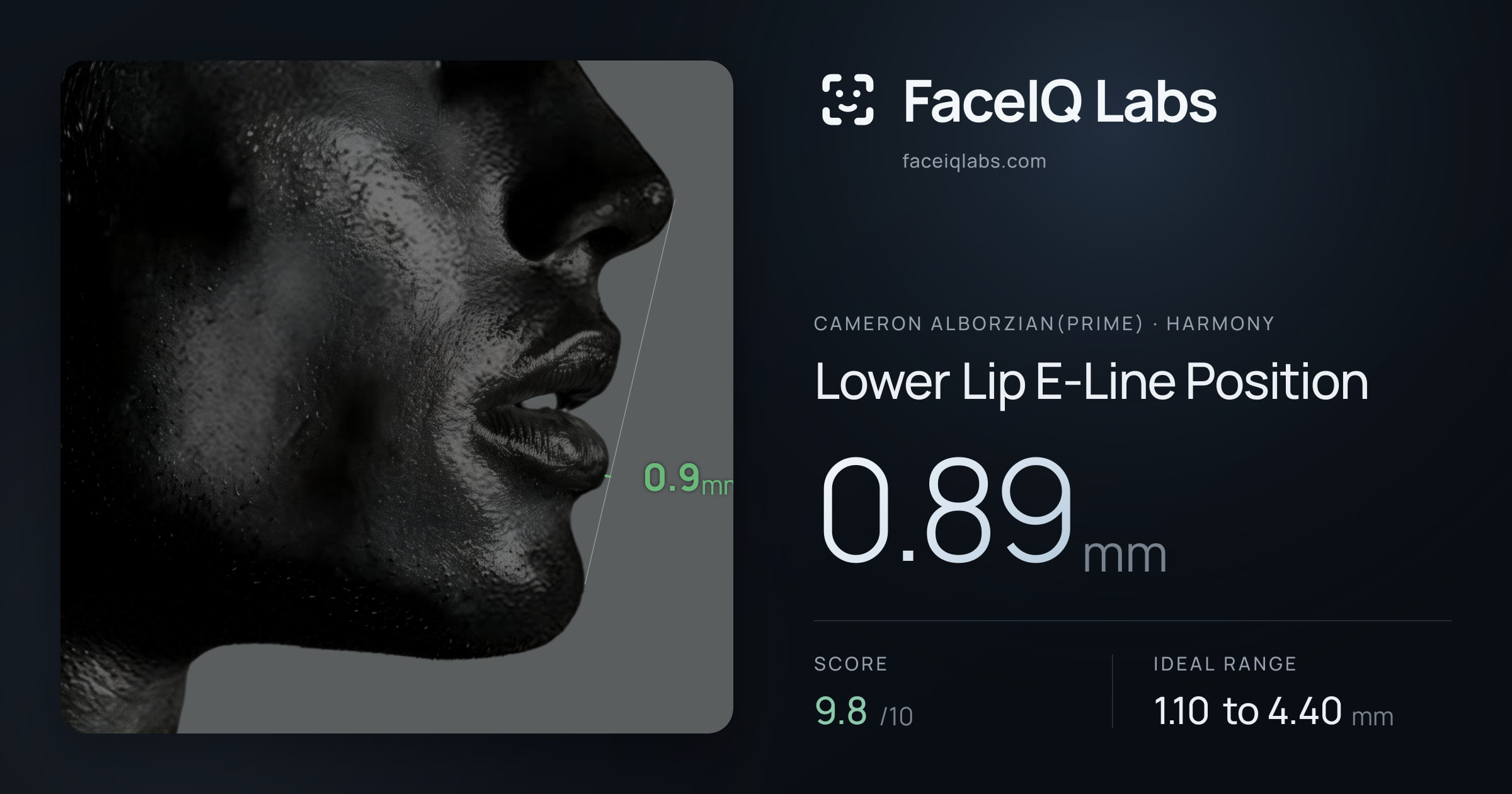 Cameron Alborzian(Prime) Lower Lip E-Line Position: 0.89mm, drawn on the photo