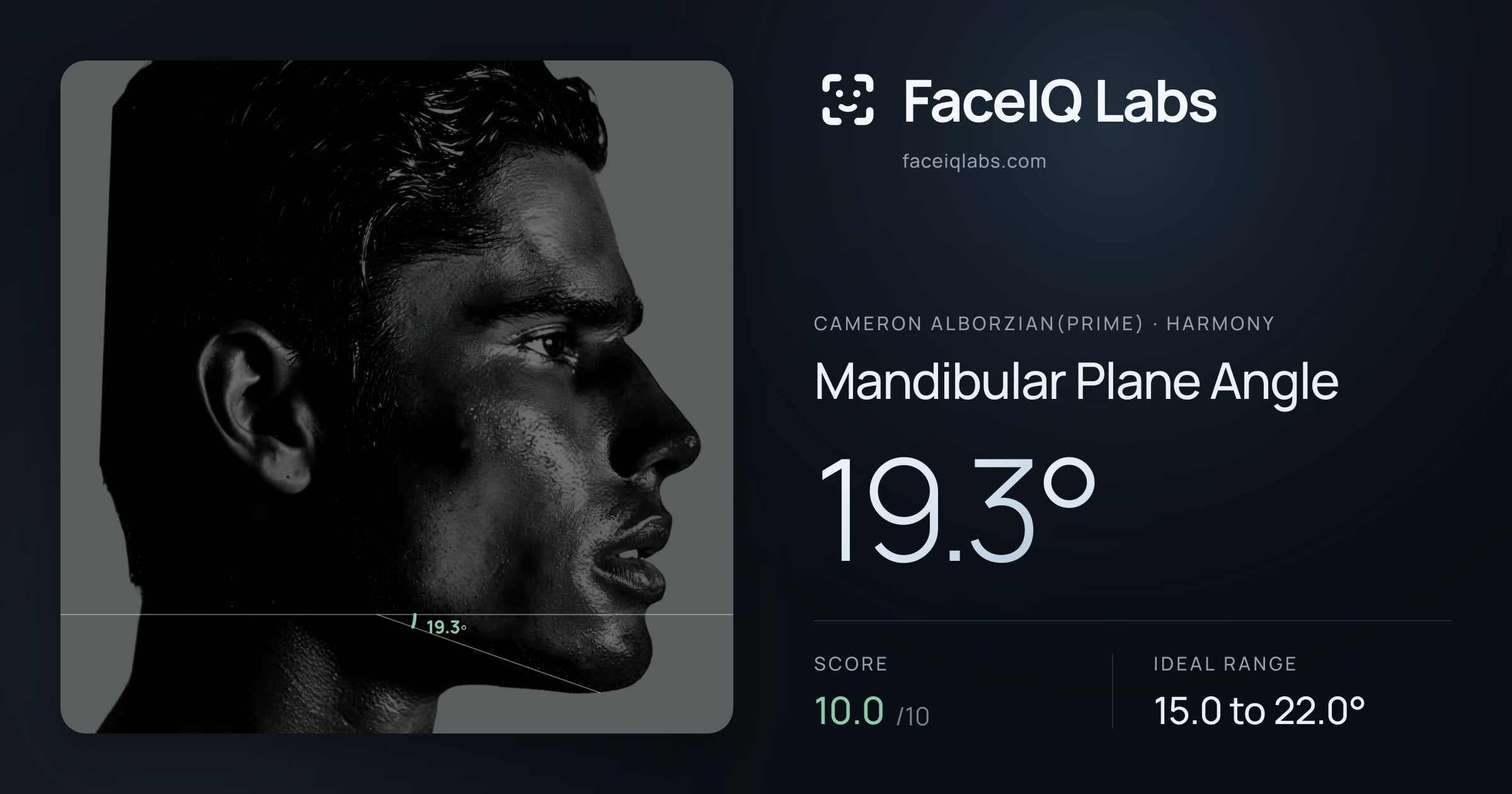 Cameron Alborzian(Prime) Mandibular Plane Angle: 19.3°, drawn on the photo