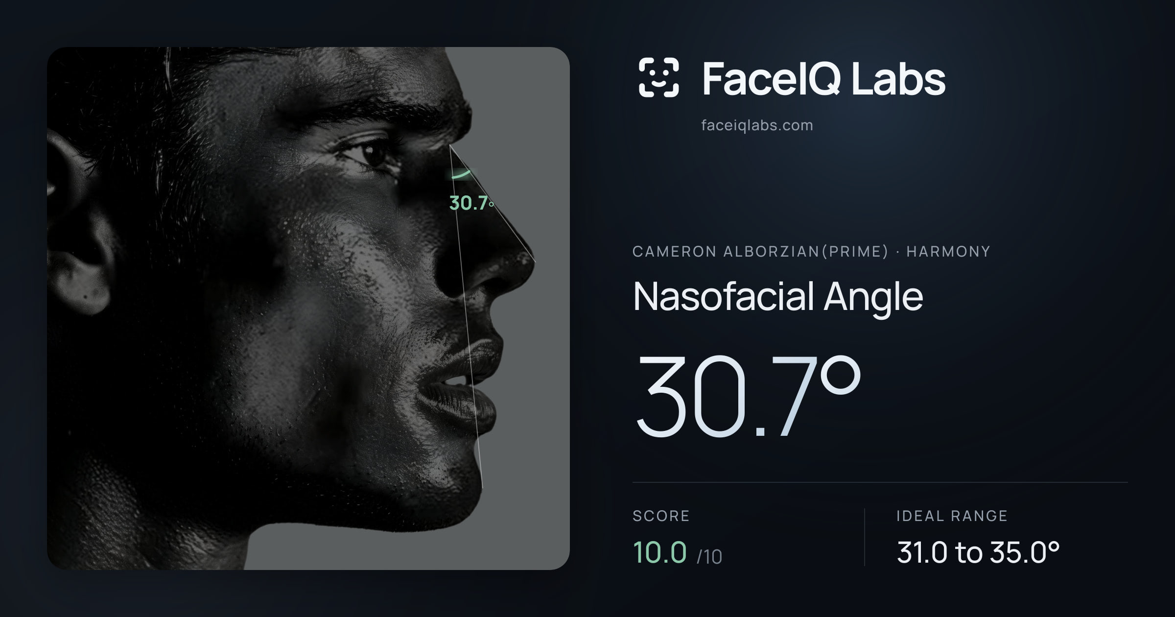 Cameron Alborzian(Prime) Nasofacial Angle: 30.7°, drawn on the photo