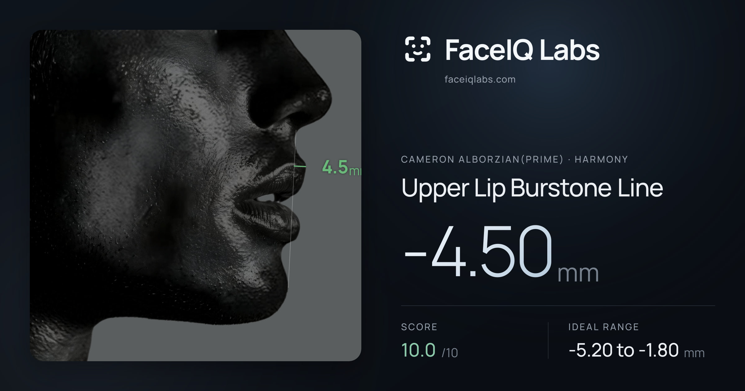 Cameron Alborzian(Prime) Upper Lip Burstone Line: -4.50mm, drawn on the photo