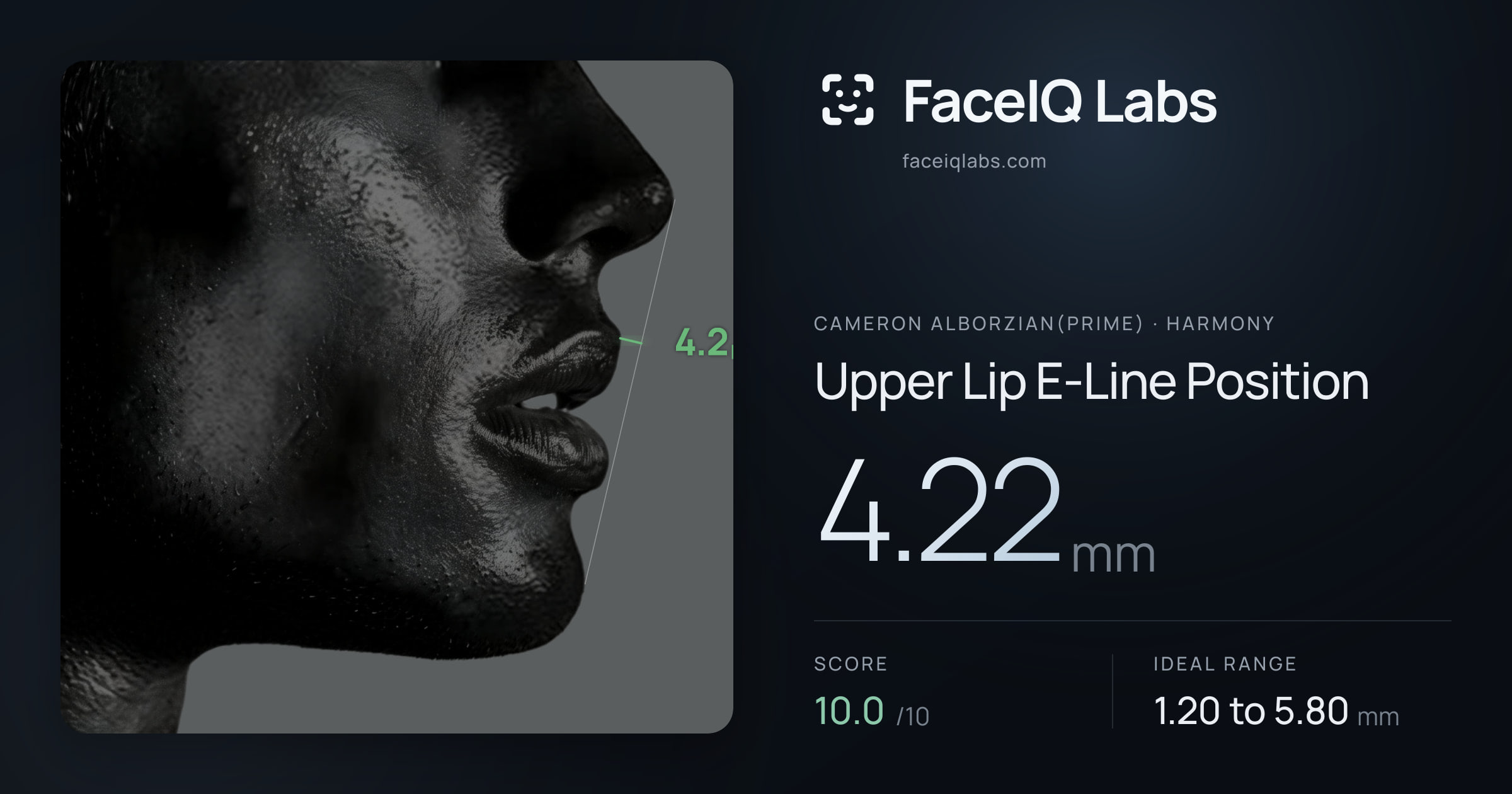 Cameron Alborzian(Prime) Upper Lip E-Line Position: 4.22mm, drawn on the photo
