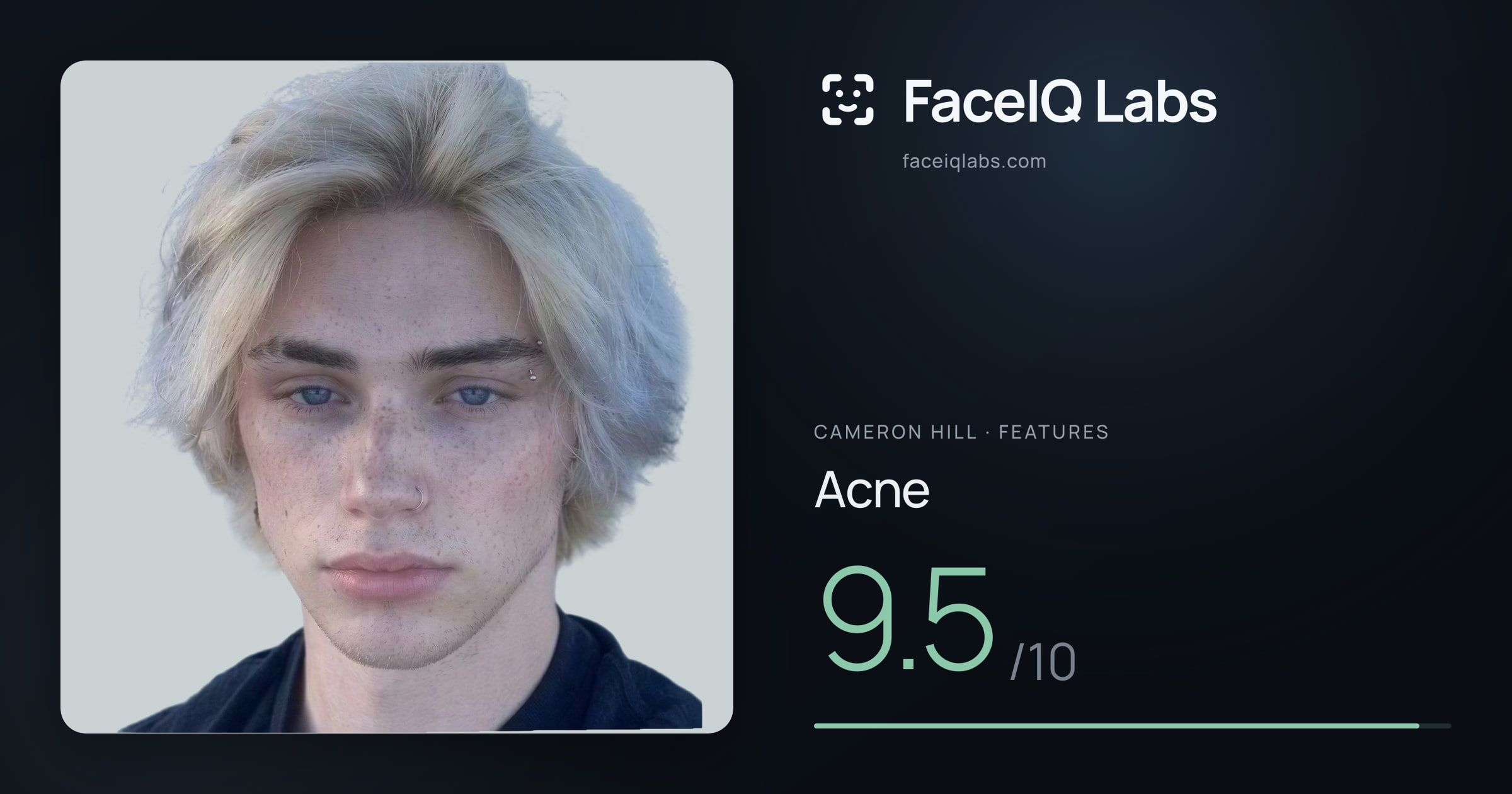 Cameron Hill Acne: 9.5/10, drawn on the photo