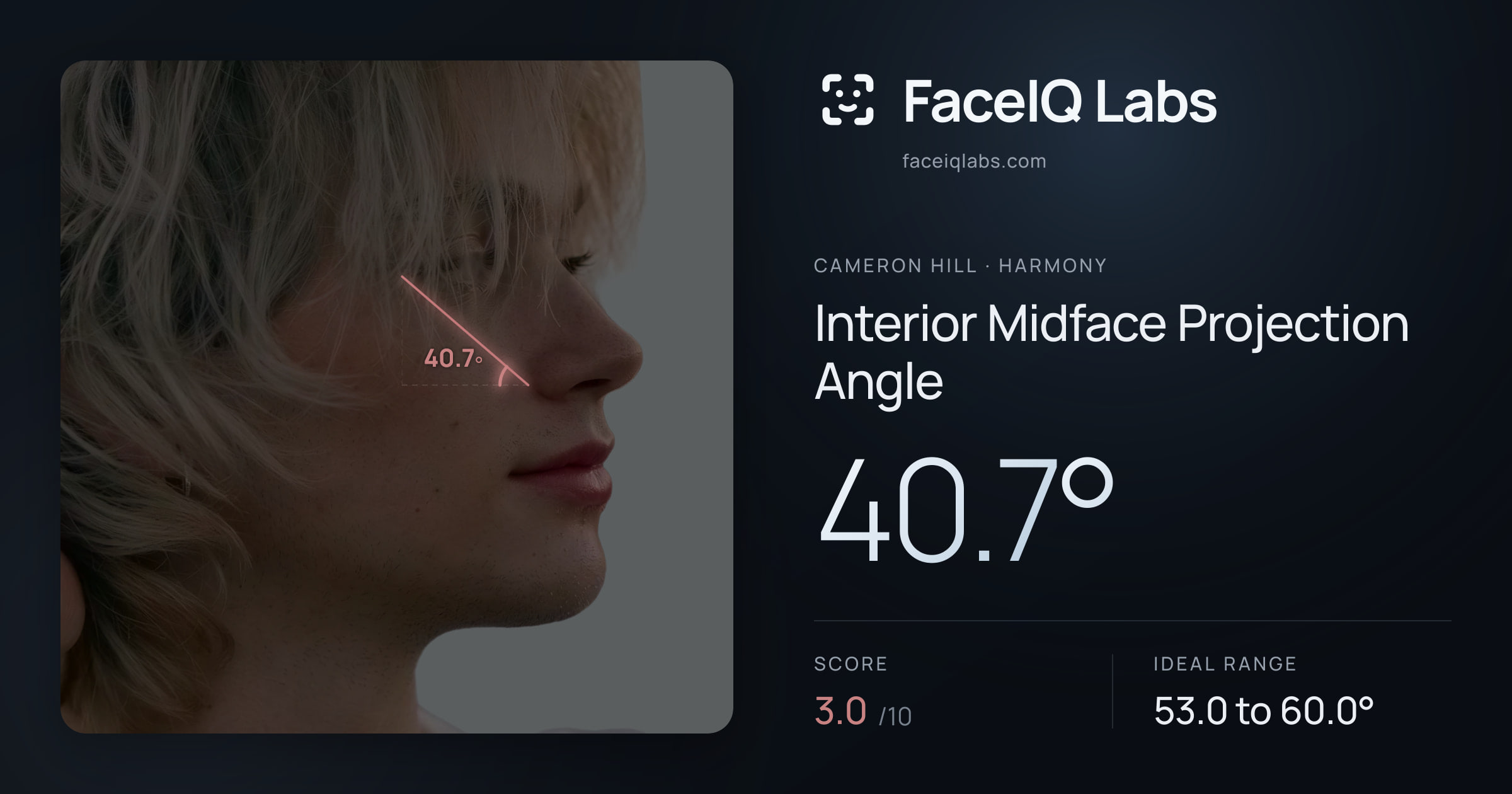 Cameron Hill Interior Midface Projection Angle: 40.7°, drawn on the photo