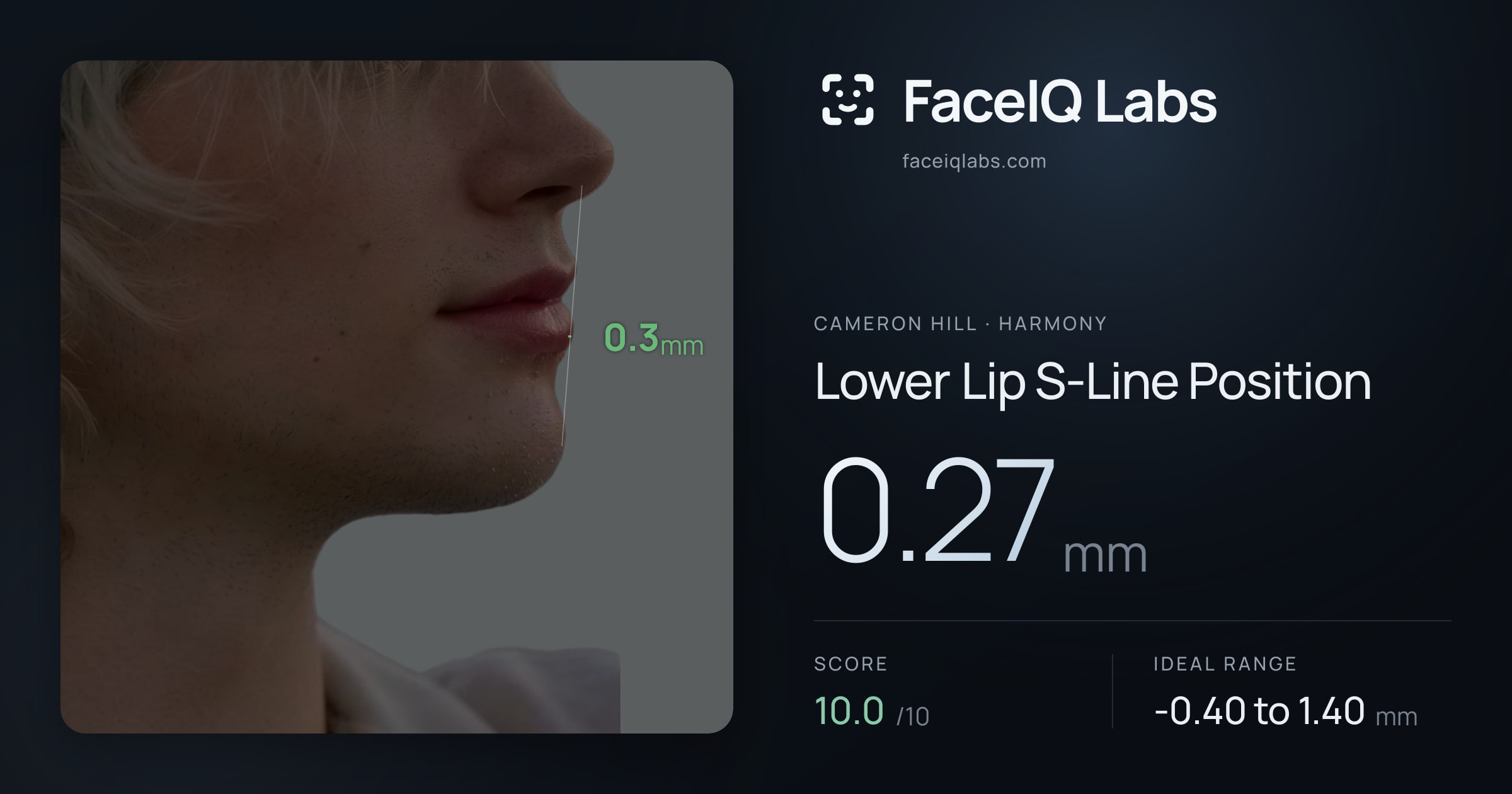 Cameron Hill Lower Lip S-Line Position: 0.27mm, drawn on the photo