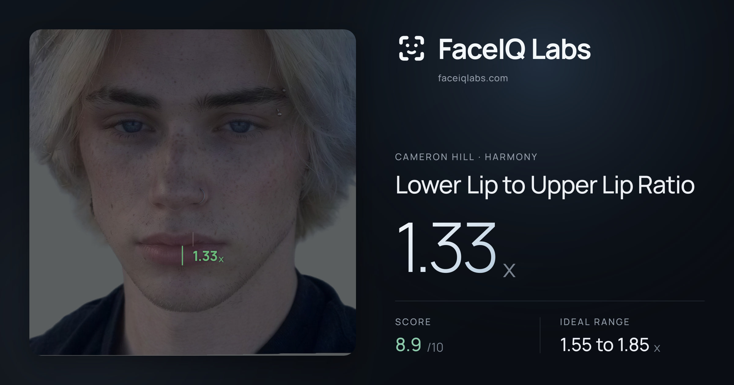 Cameron Hill Lower Lip to Upper Lip Ratio: 1.33x, drawn on the photo