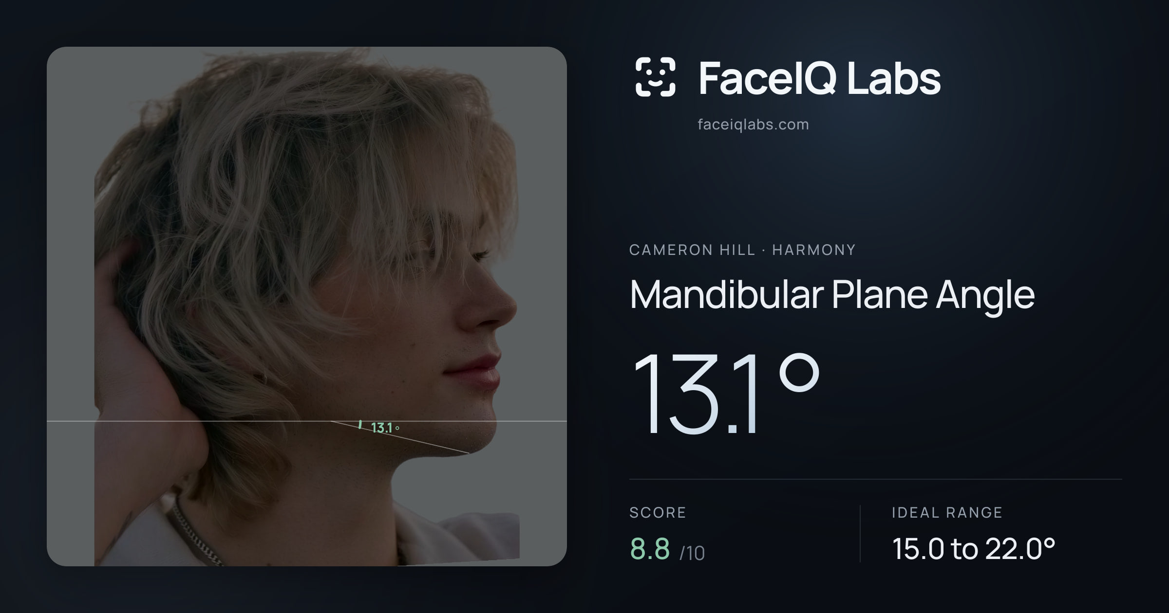 Cameron Hill Mandibular Plane Angle: 13.1°, drawn on the photo