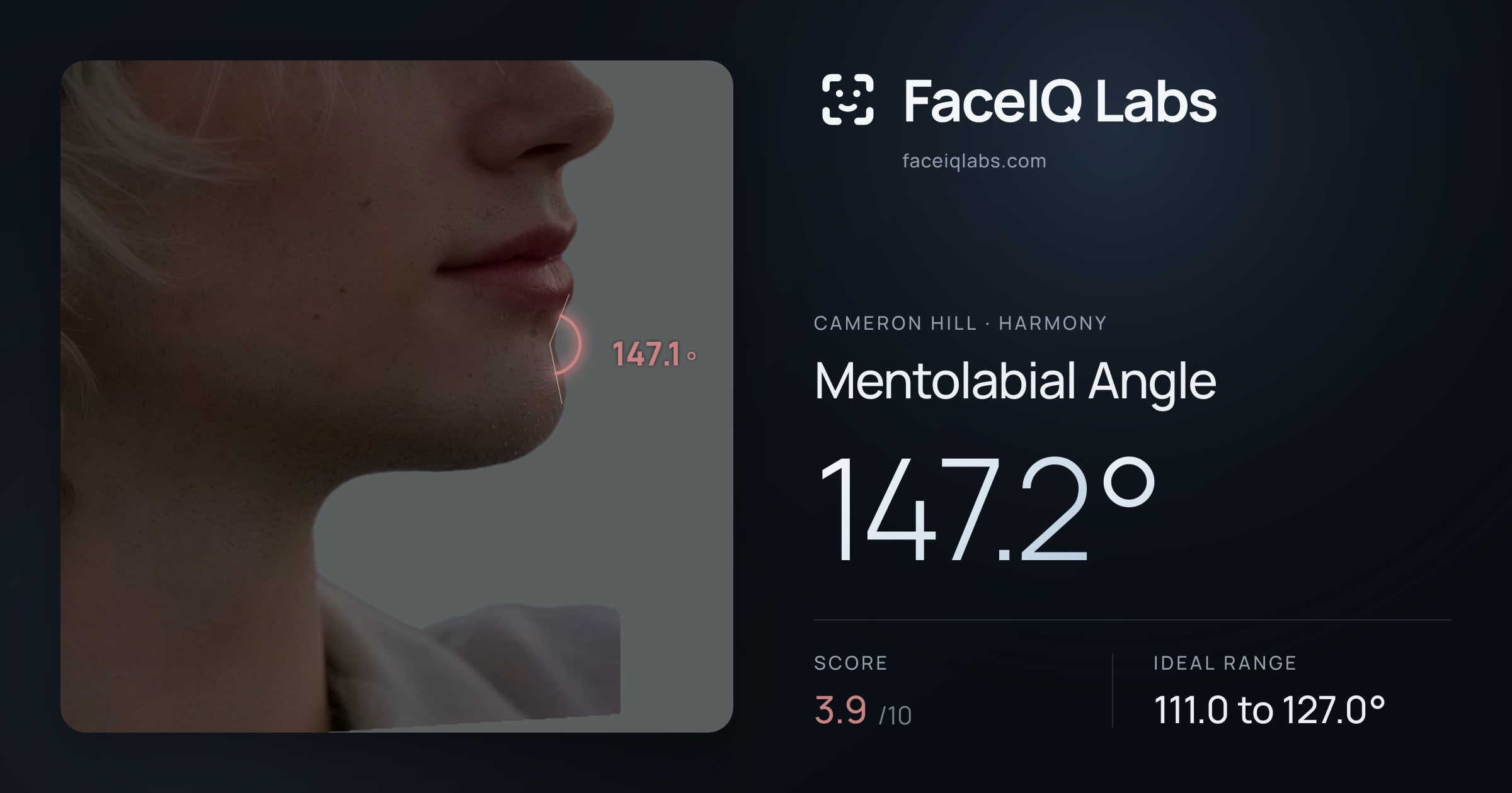 Cameron Hill Mentolabial Angle: 147.2°, drawn on the photo