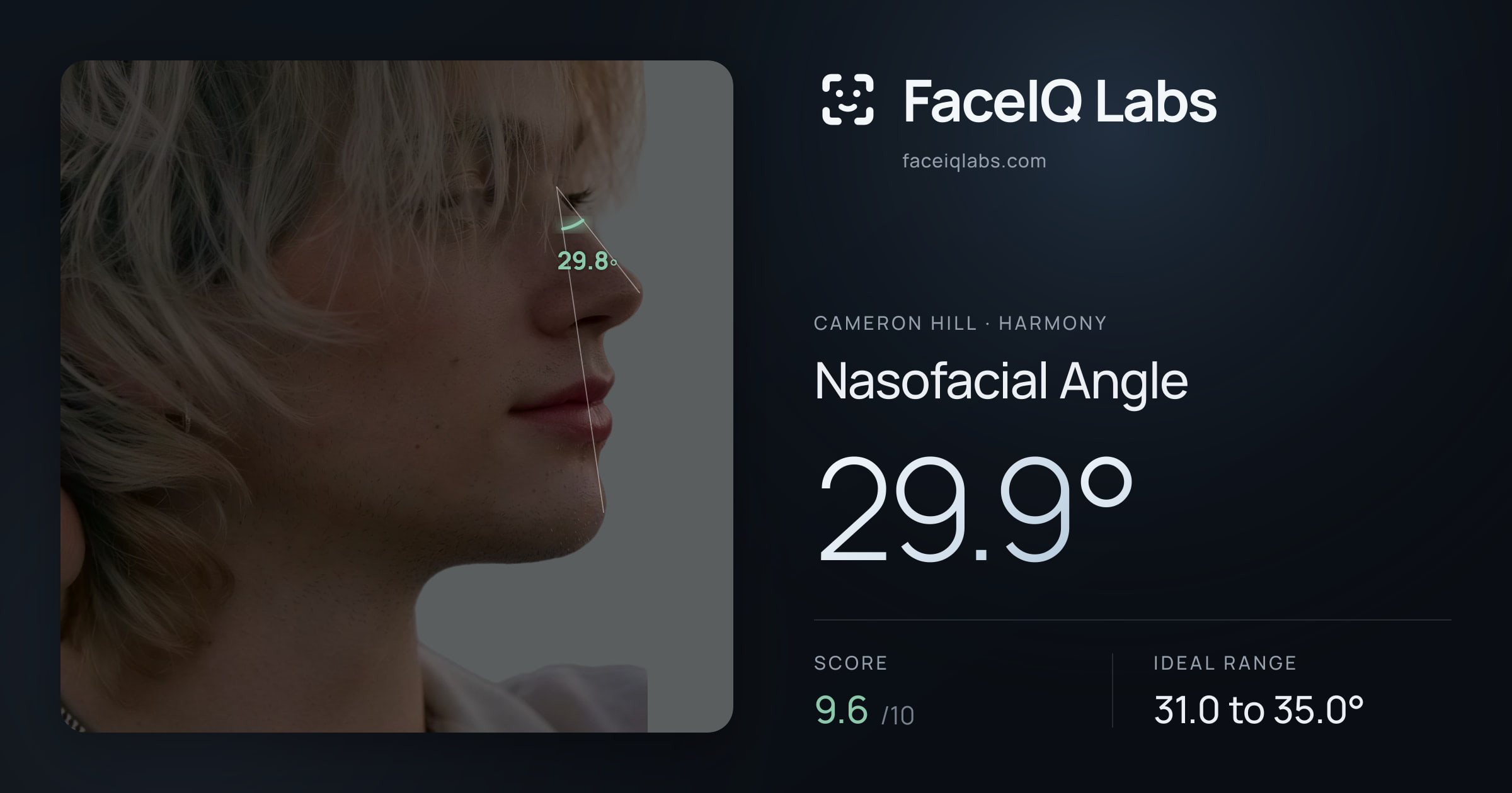 Cameron Hill Nasofacial Angle: 29.9°, drawn on the photo