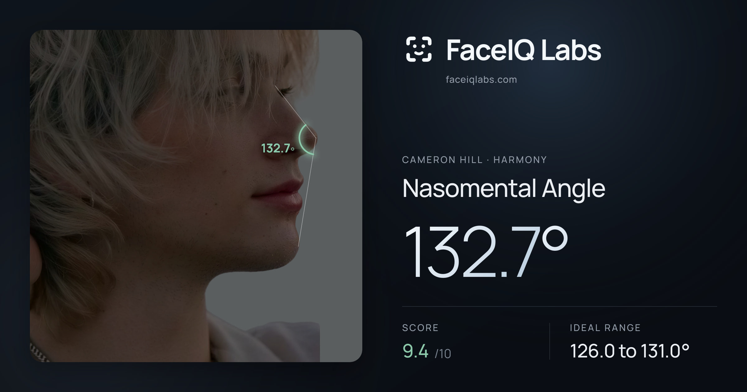 Cameron Hill Nasomental Angle: 132.7°, drawn on the photo