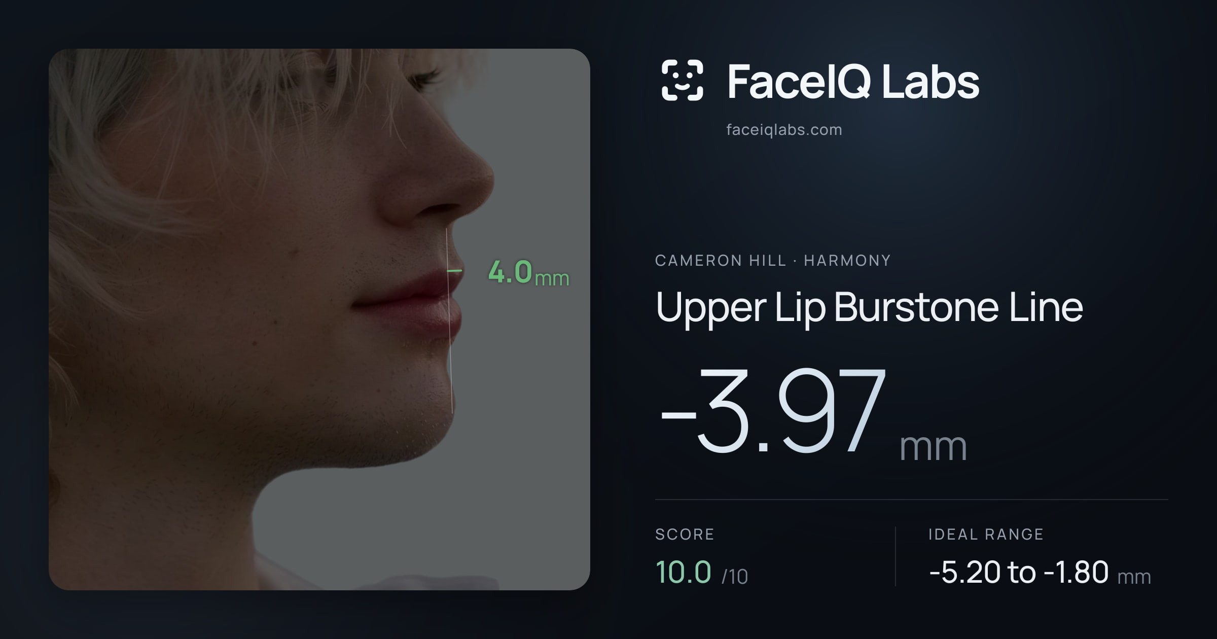 Cameron Hill Upper Lip Burstone Line: -3.97mm, drawn on the photo