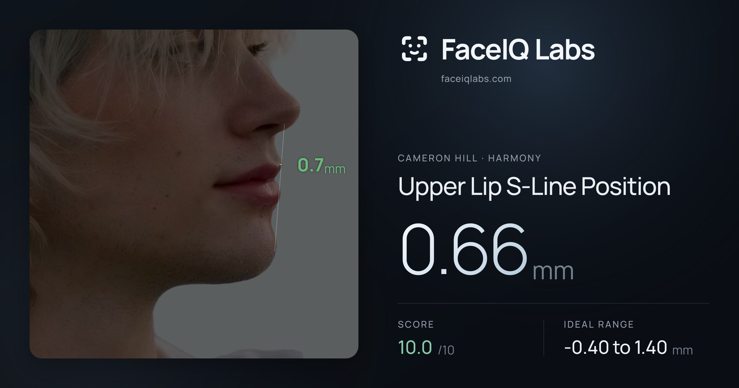 Cameron Hill Upper Lip S-Line Position: 0.66mm, drawn on the photo