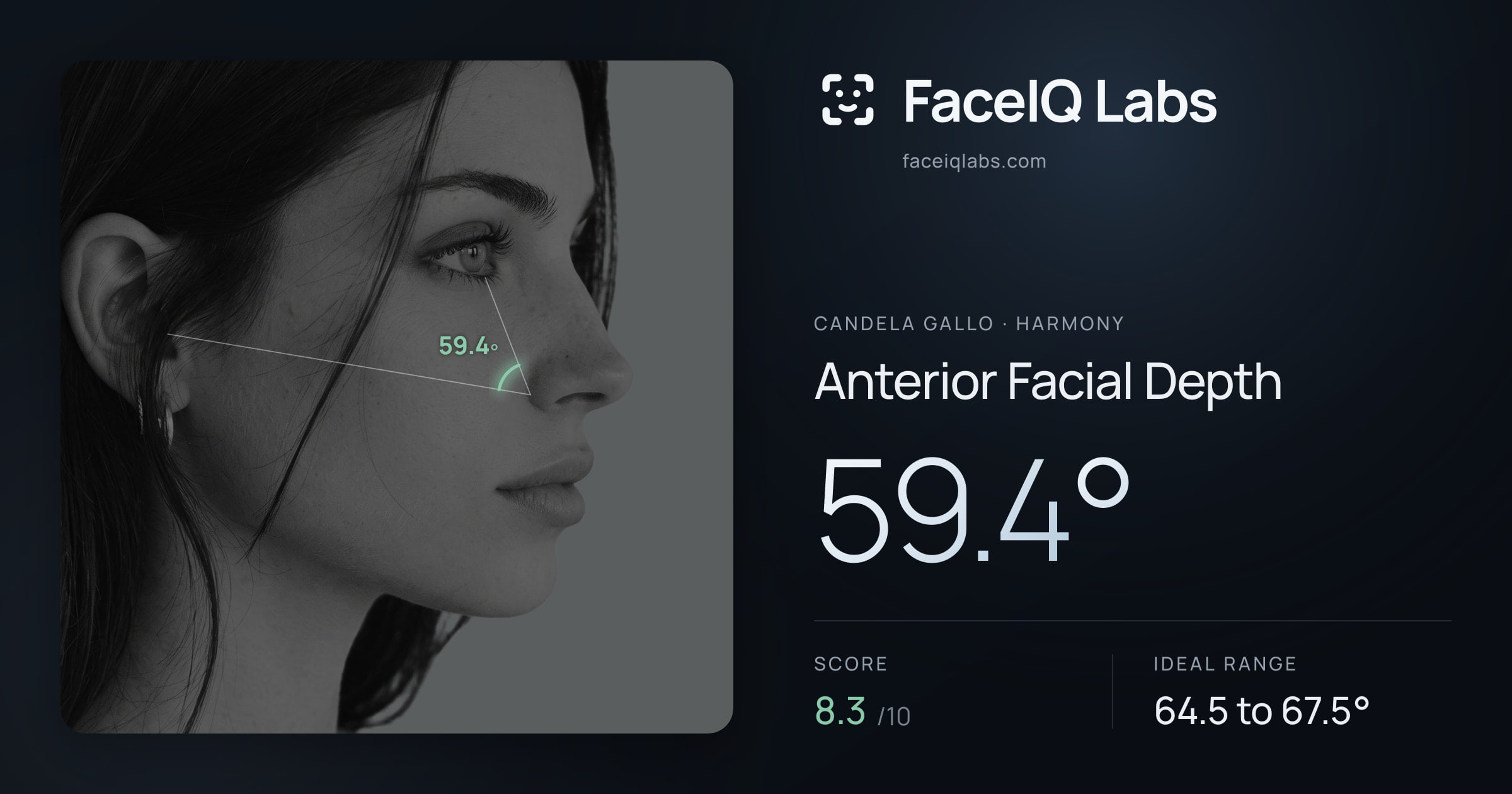Candela Gallo Anterior Facial Depth: 59.4°, drawn on the photo