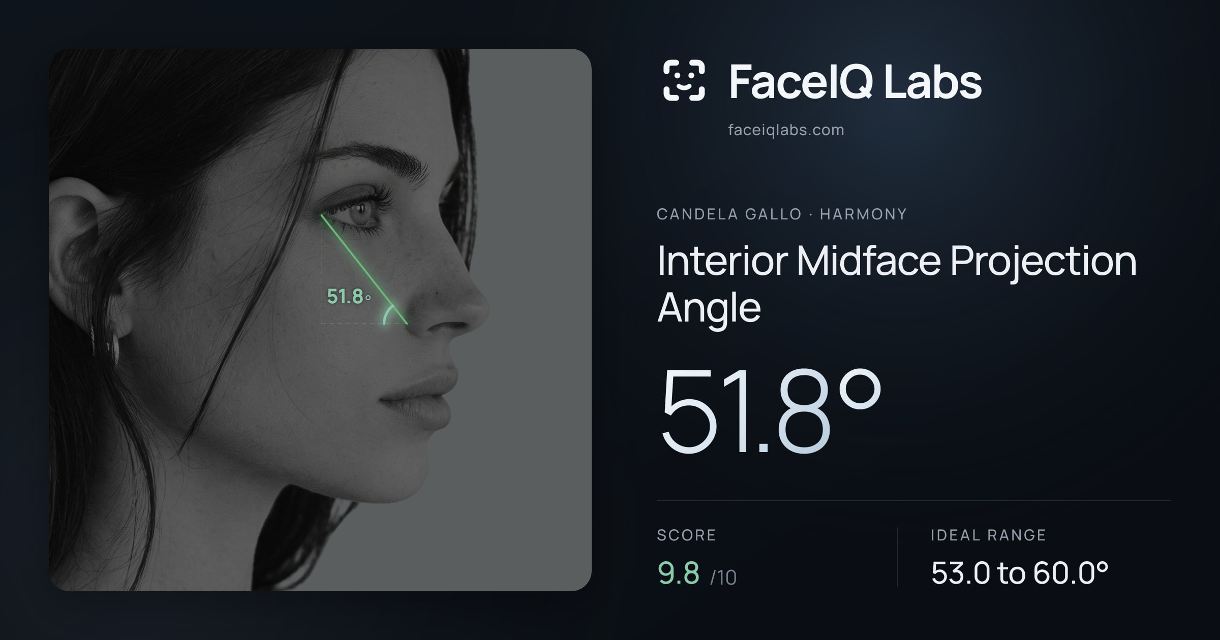 Candela Gallo Interior Midface Projection Angle: 51.8°, drawn on the photo