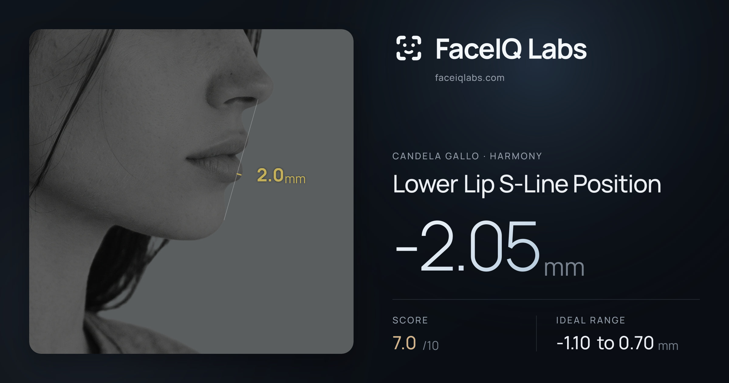 Candela Gallo Lower Lip S-Line Position: -2.05mm, drawn on the photo