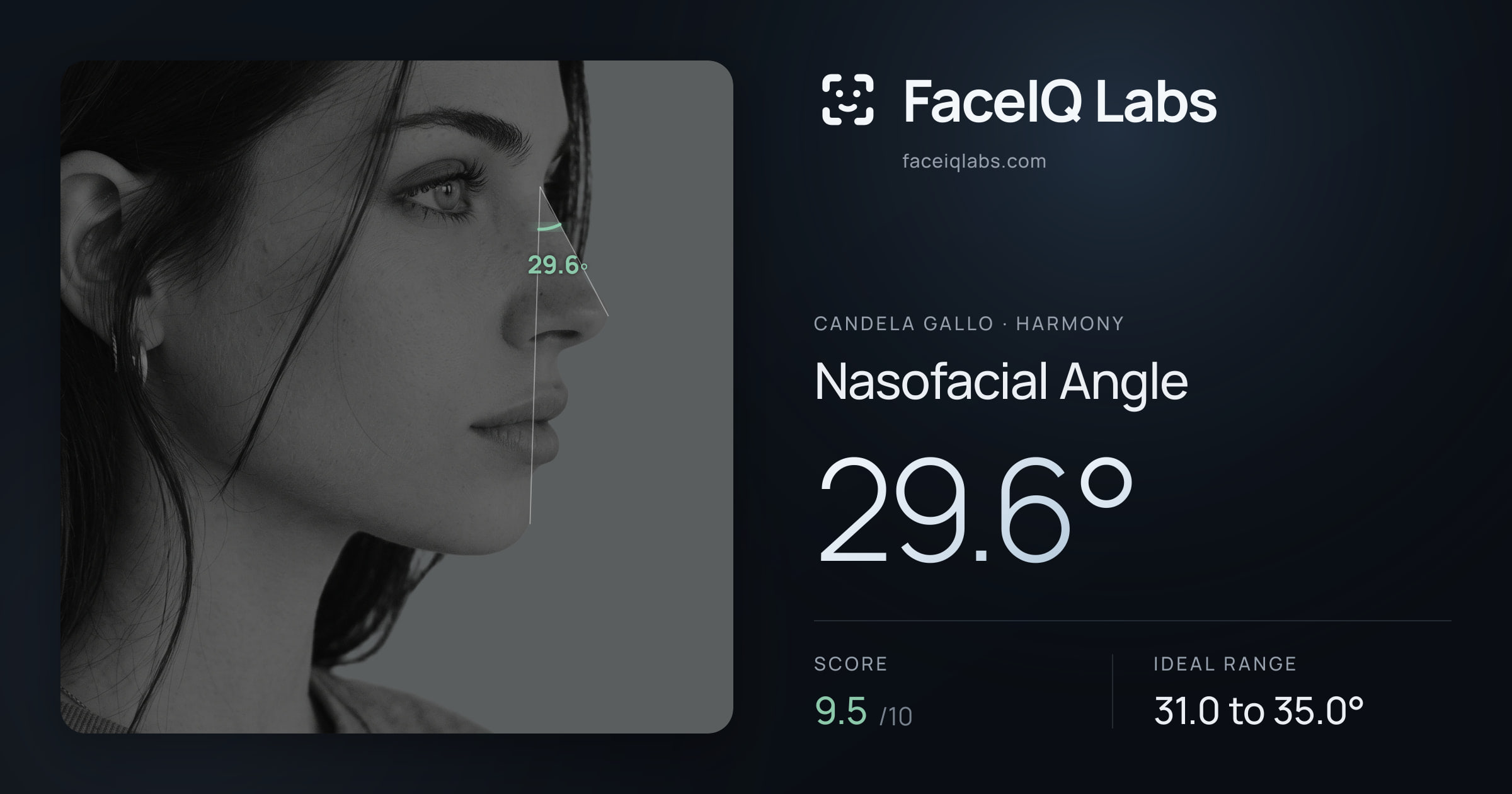 Candela Gallo Nasofacial Angle: 29.6°, drawn on the photo