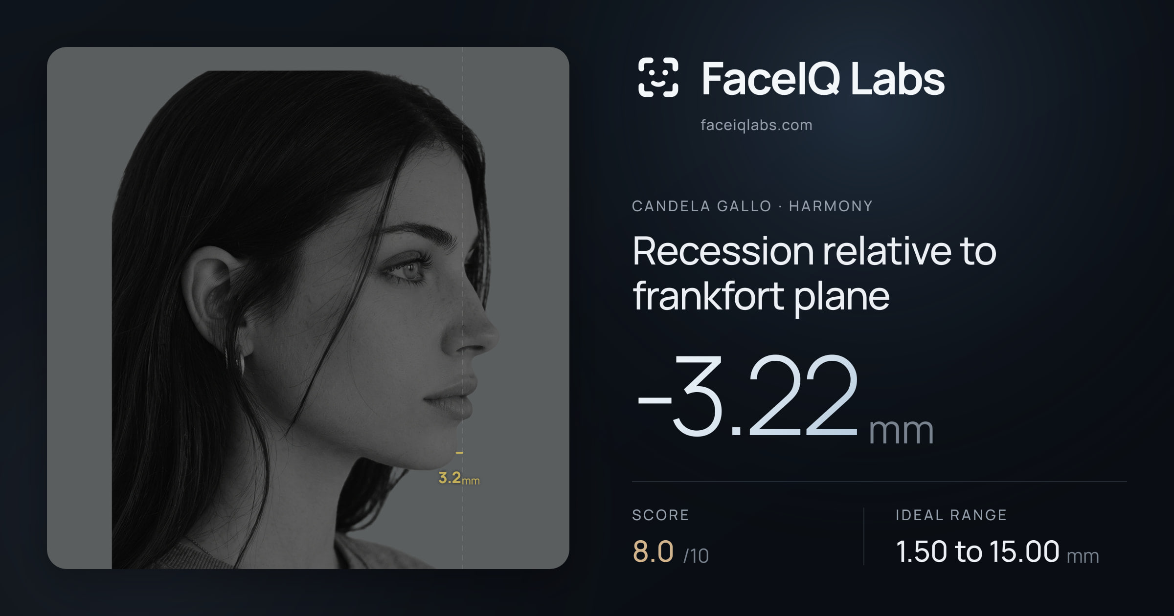 Candela Gallo Recession relative to frankfort plane: -3.22mm, drawn on the photo