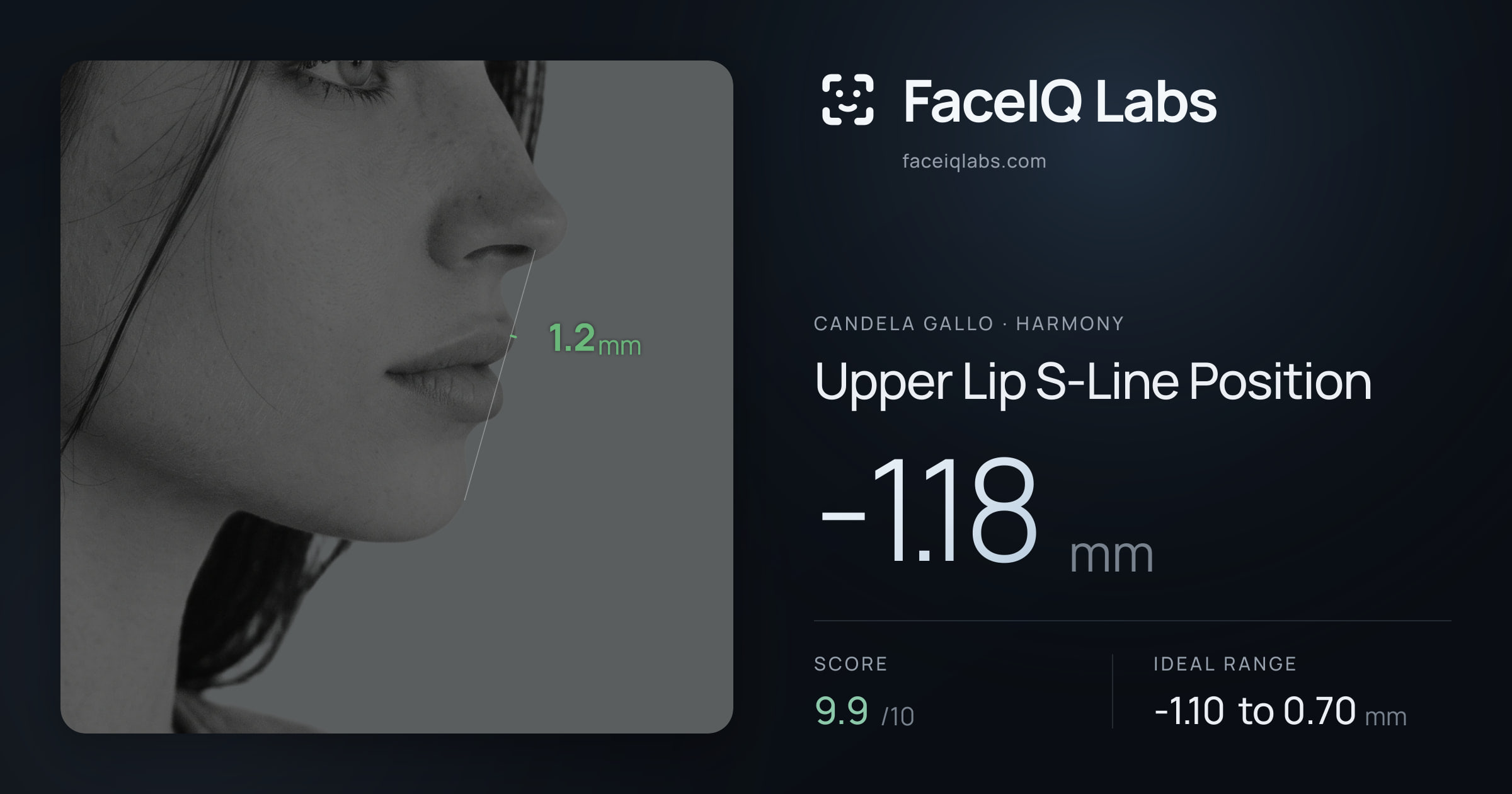 Candela Gallo Upper Lip S-Line Position: -1.18mm, drawn on the photo