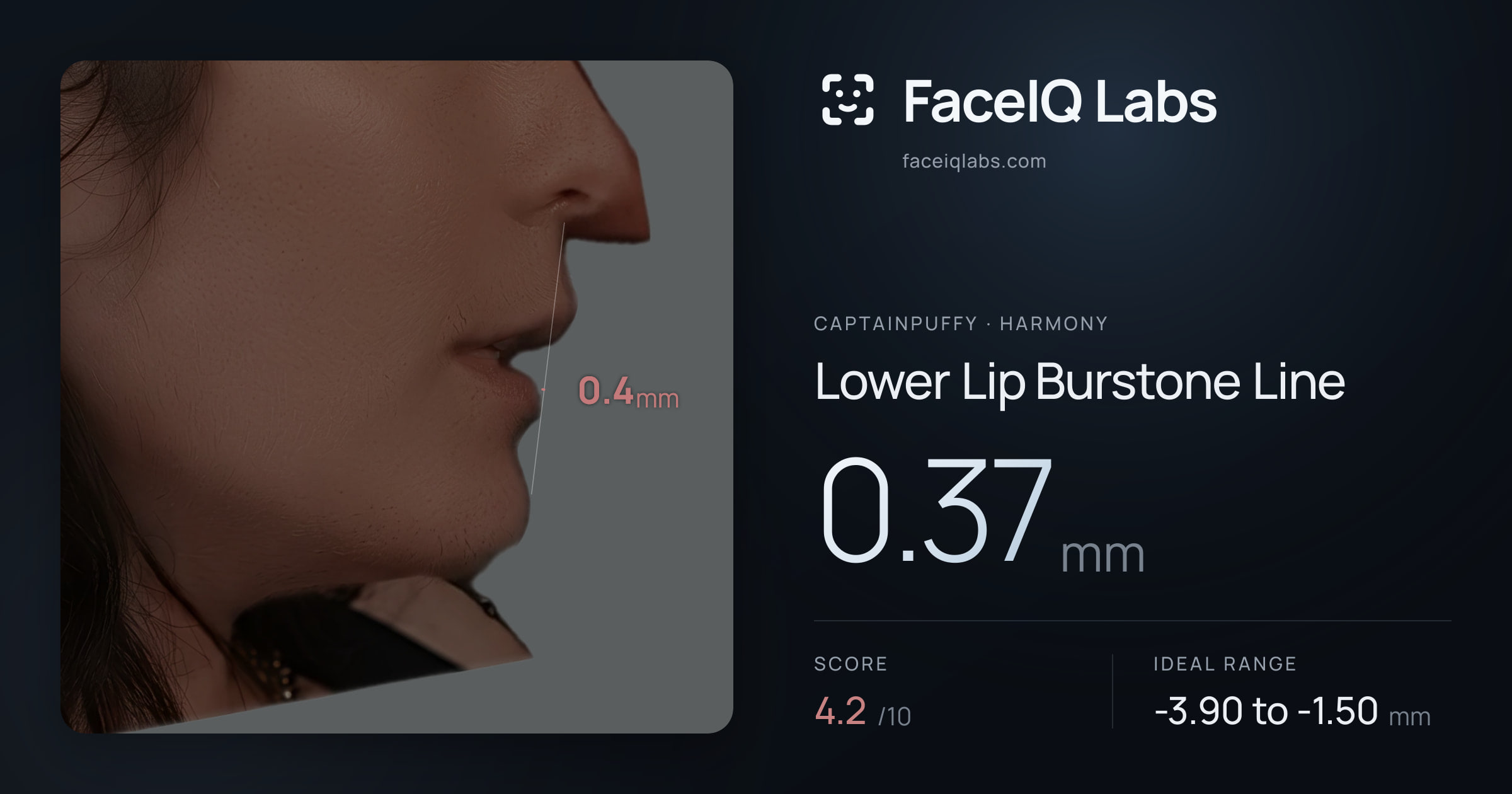 CaptainPuffy Lower Lip Burstone Line: 0.37mm, drawn on the photo