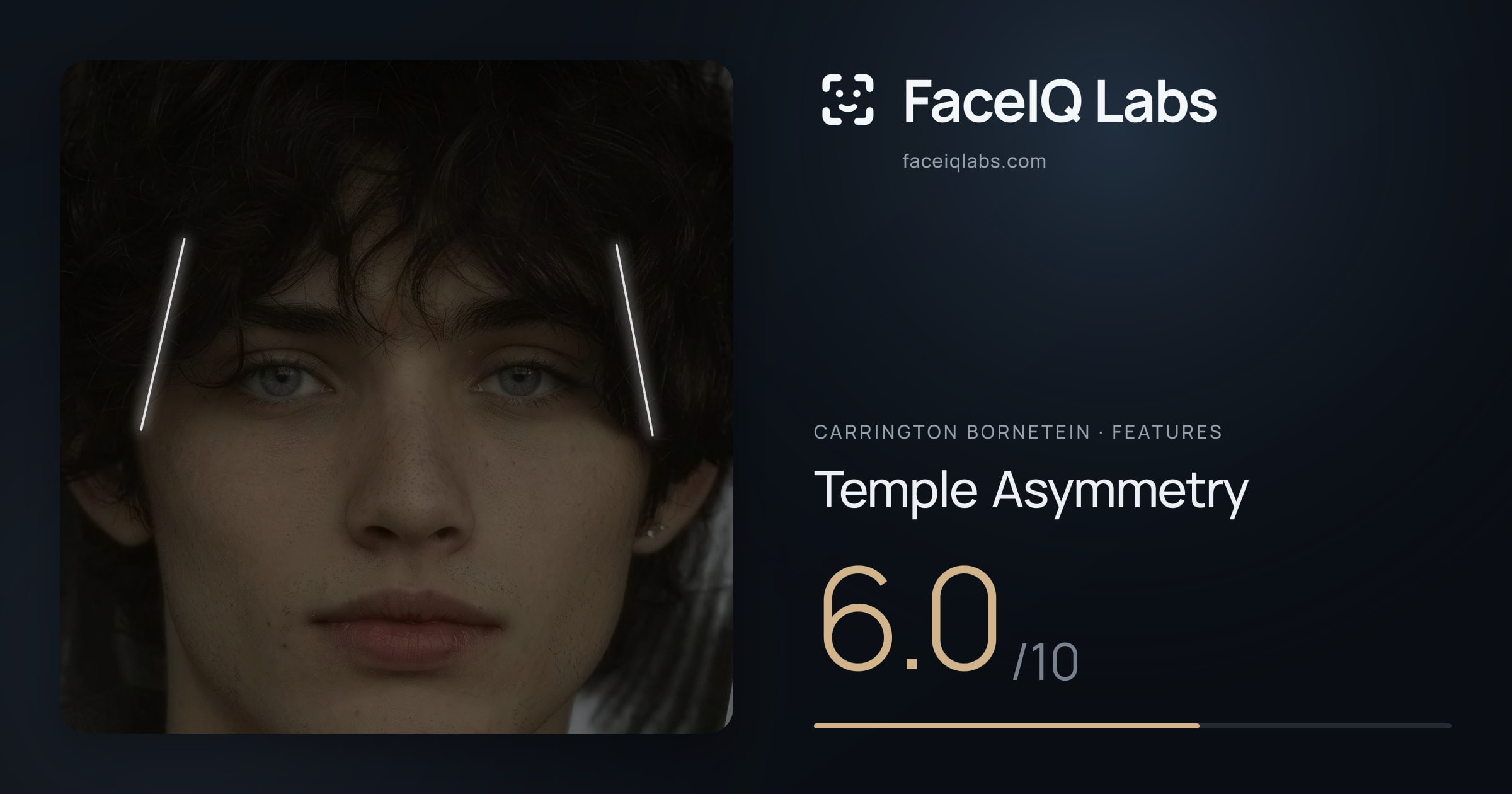 Carrington Bornetein Temple Asymmetry: 6.0/10, drawn on the photo