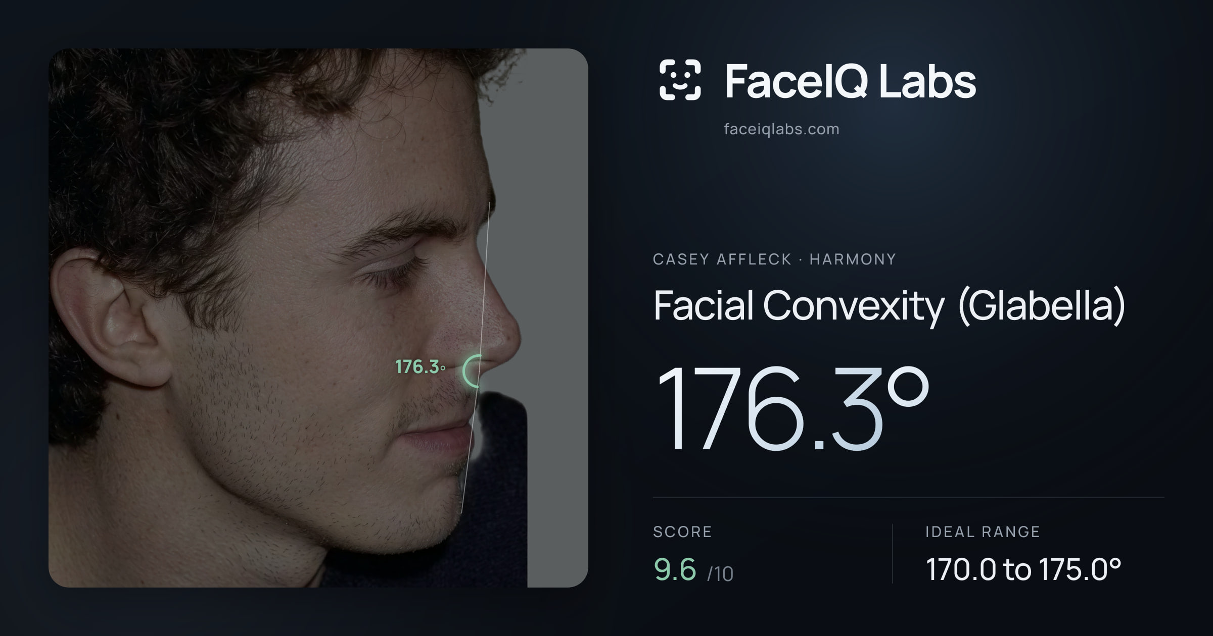 Casey Affleck Facial Convexity (Glabella): 176.3°, drawn on the photo