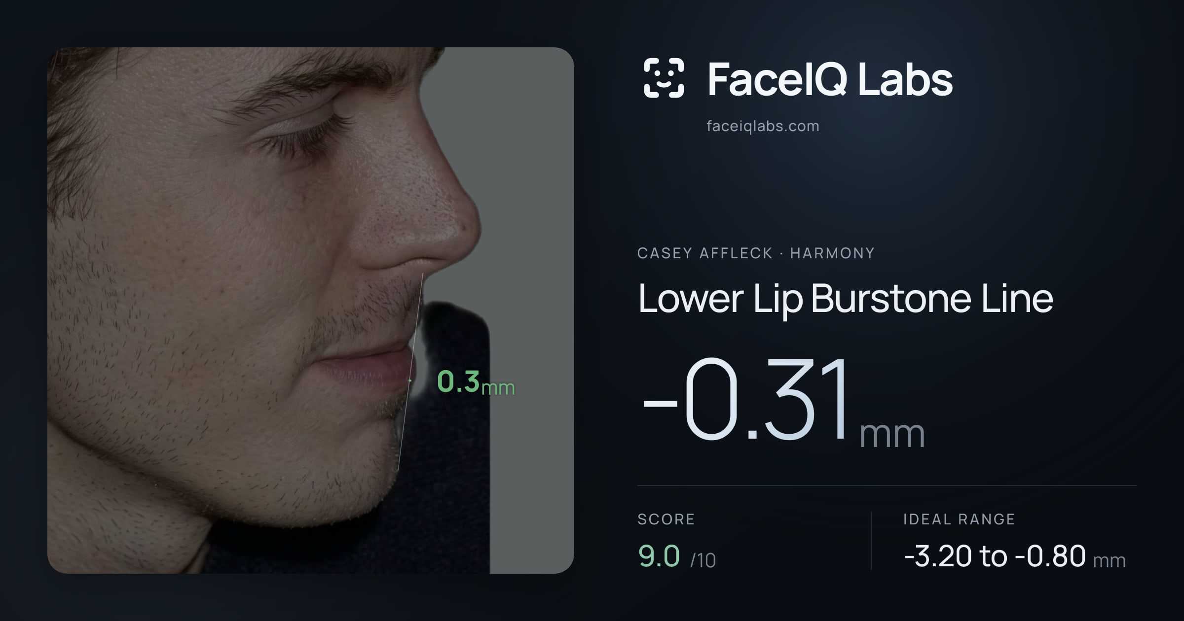 Casey Affleck Lower Lip Burstone Line: -0.31mm, drawn on the photo