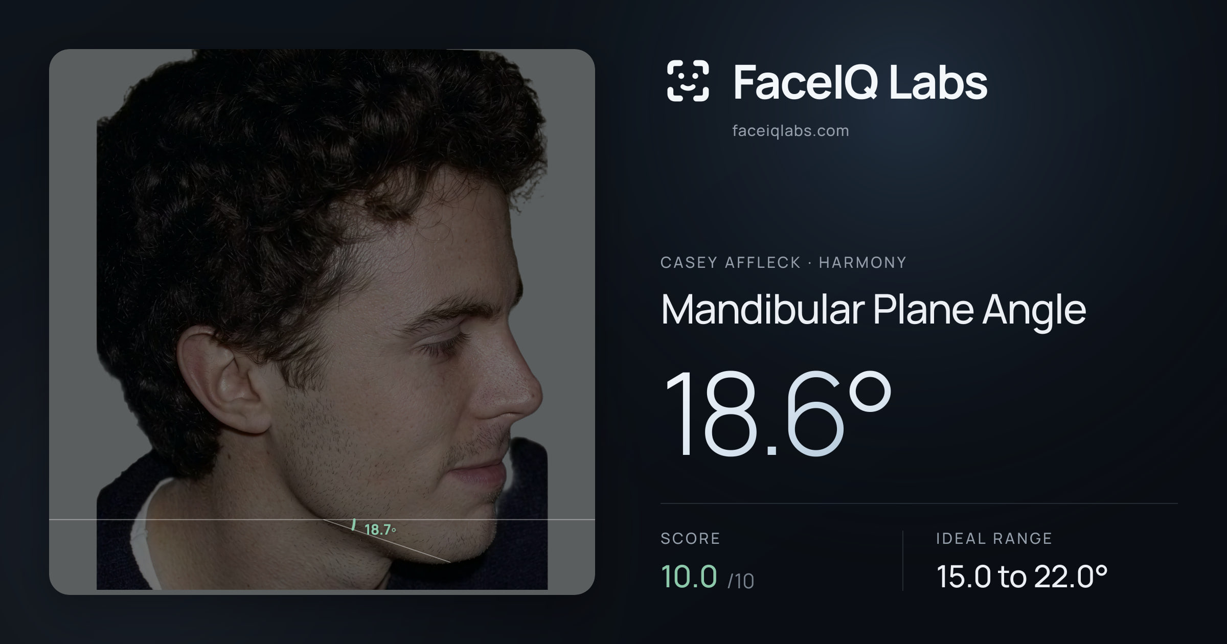 Casey Affleck Mandibular Plane Angle: 18.6°, drawn on the photo