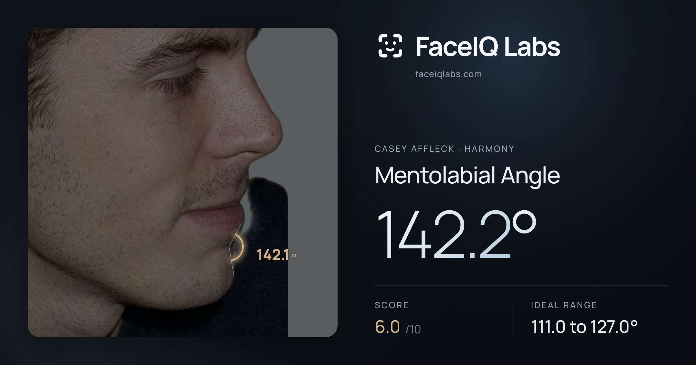 Casey Affleck Mentolabial Angle: 142.2°, drawn on the photo