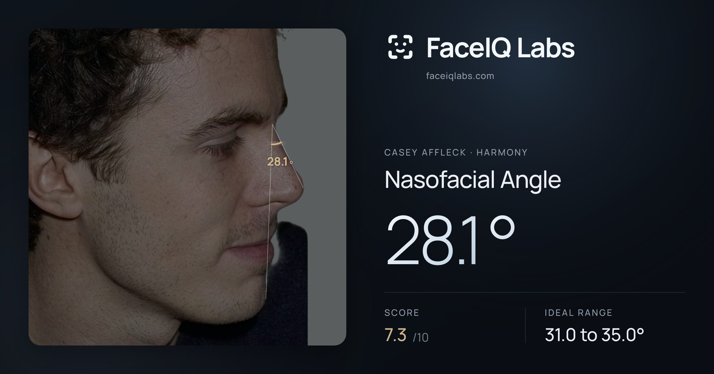 Casey Affleck Nasofacial Angle: 28.1°, drawn on the photo