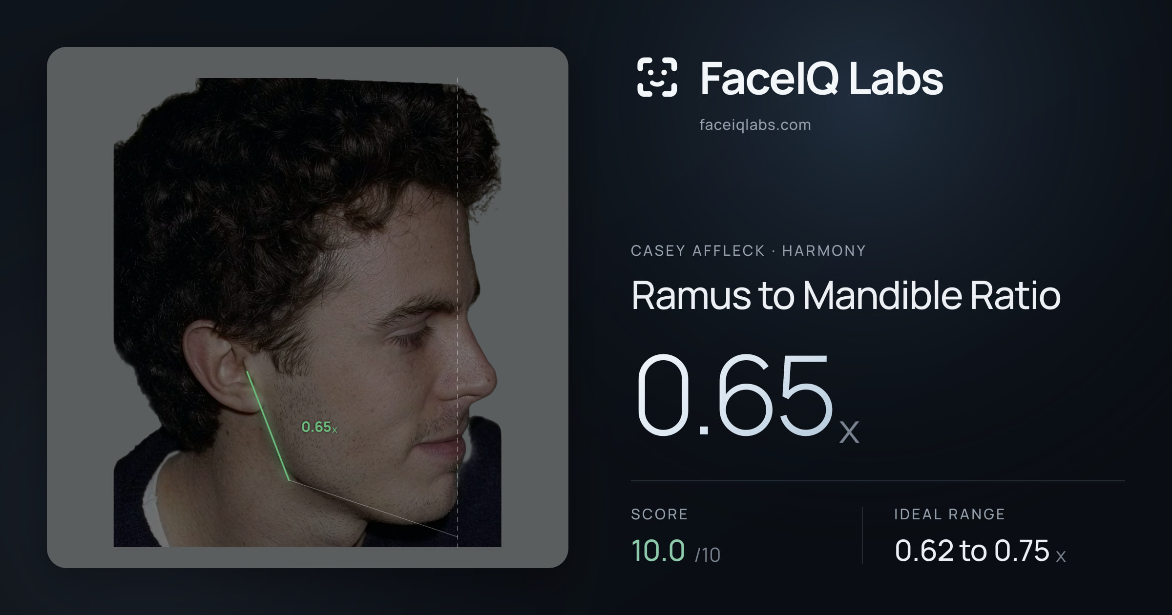 Casey Affleck Ramus to Mandible Ratio: 0.65x, drawn on the photo