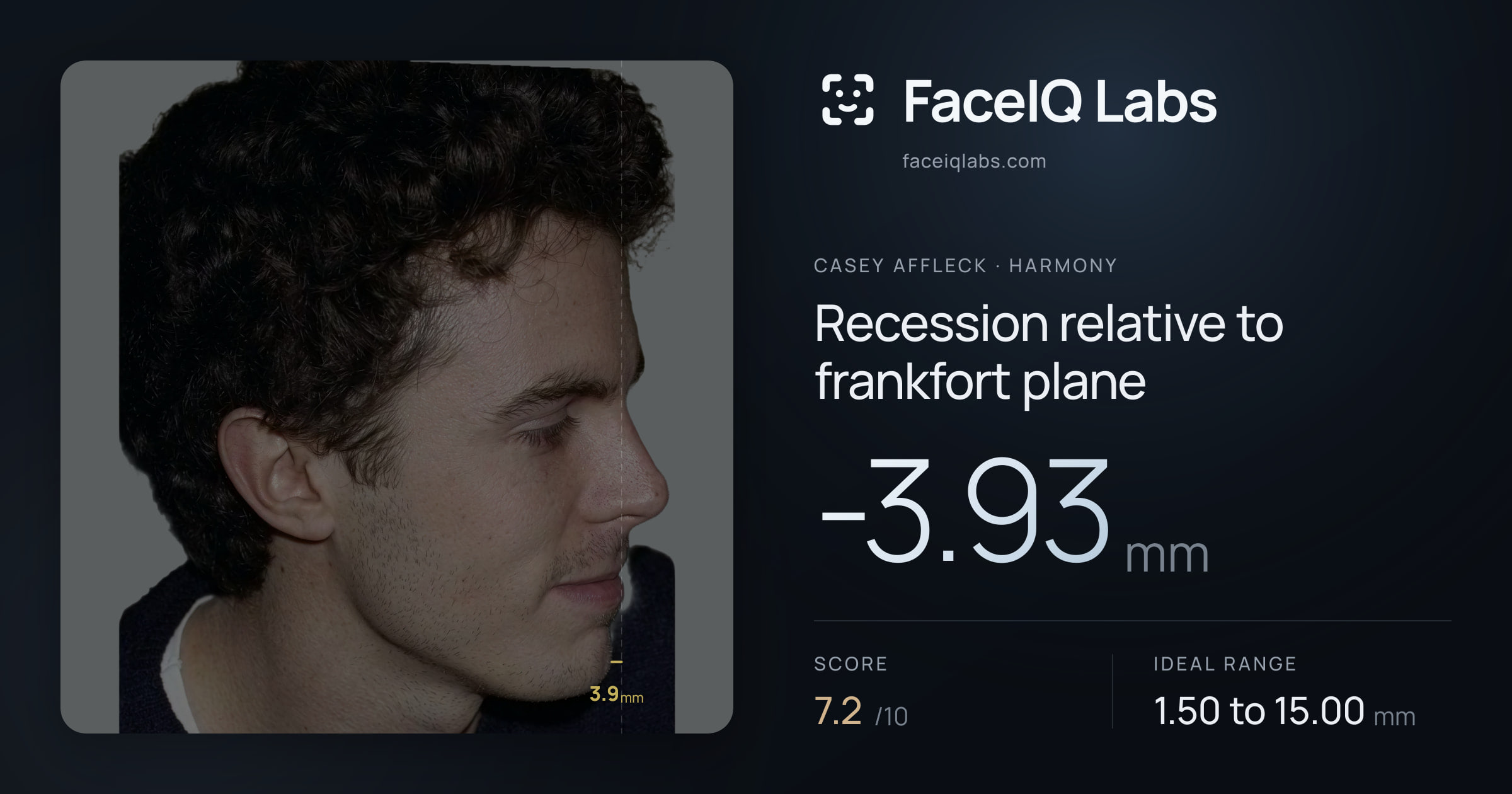 Casey Affleck Recession relative to frankfort plane: -3.93mm, drawn on the photo