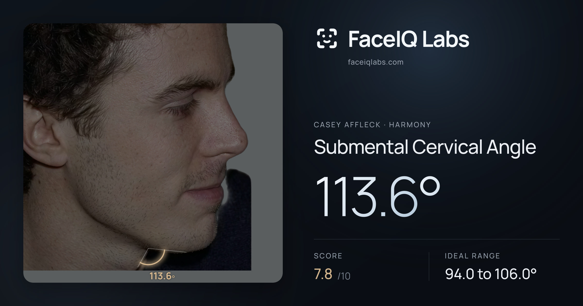 Casey Affleck Submental Cervical Angle: 113.6°, drawn on the photo