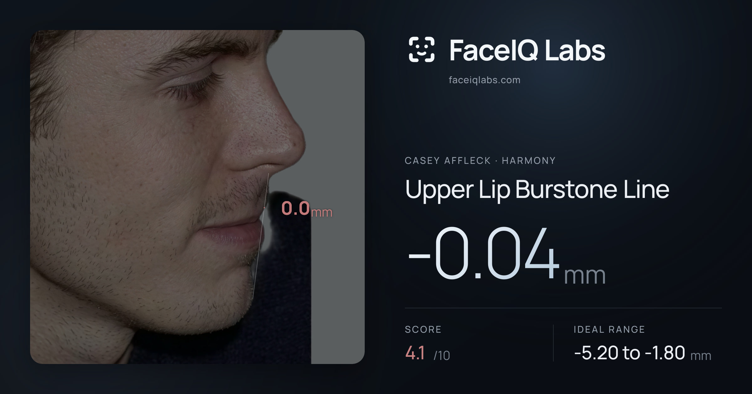 Casey Affleck Upper Lip Burstone Line: -0.04mm, drawn on the photo