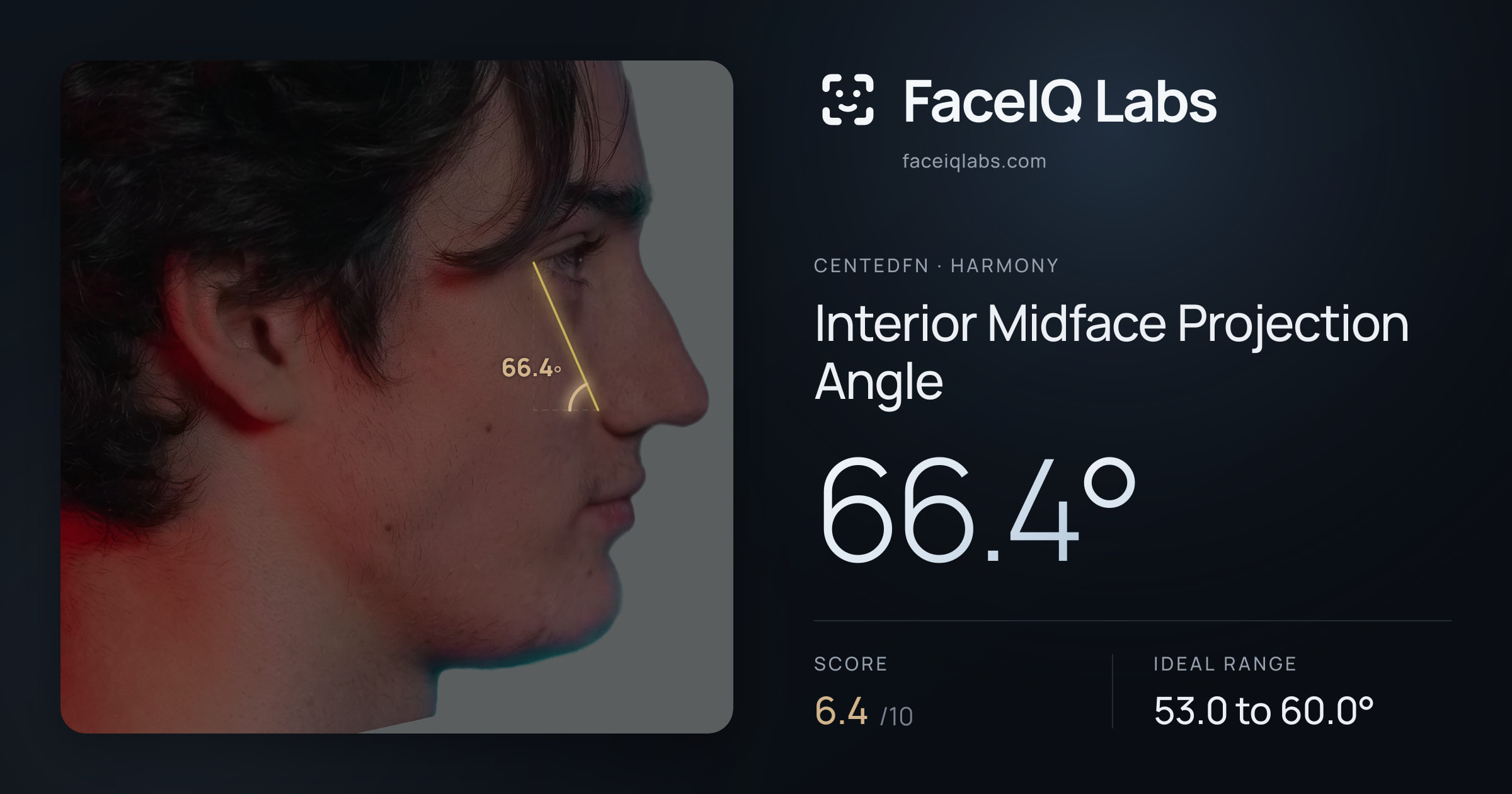 CentedFN Interior Midface Projection Angle: 66.4°, drawn on the photo