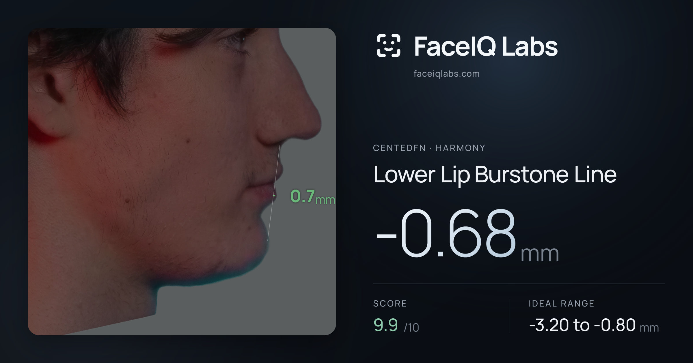 CentedFN Lower Lip Burstone Line: -0.68mm, drawn on the photo