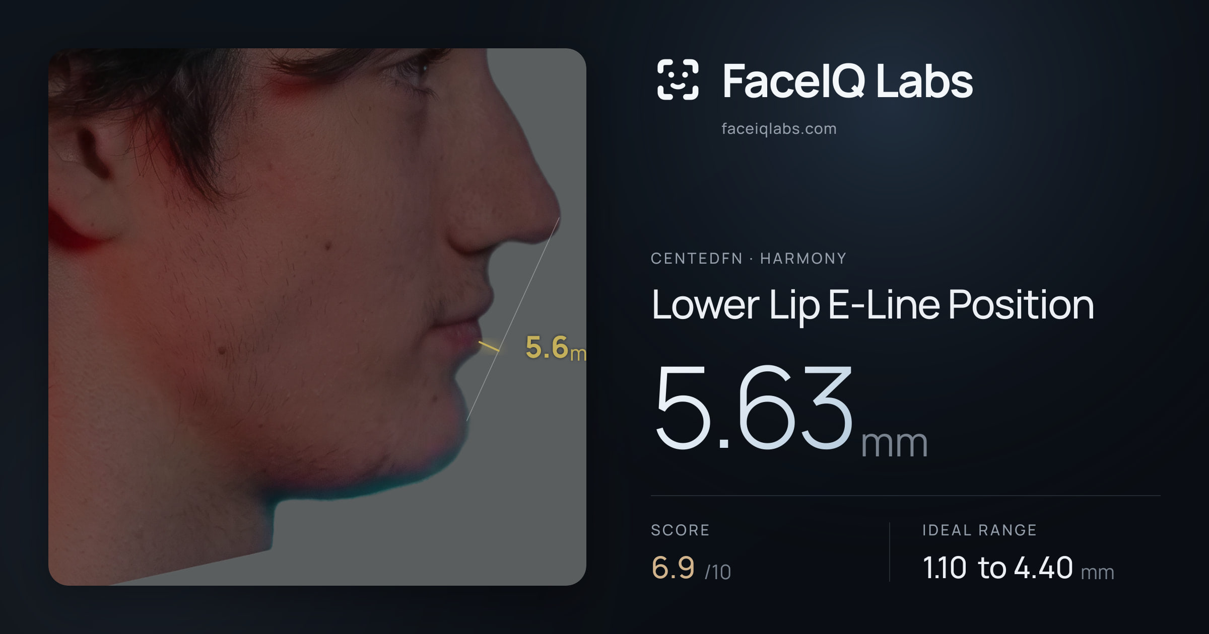 CentedFN Lower Lip E-Line Position: 5.63mm, drawn on the photo