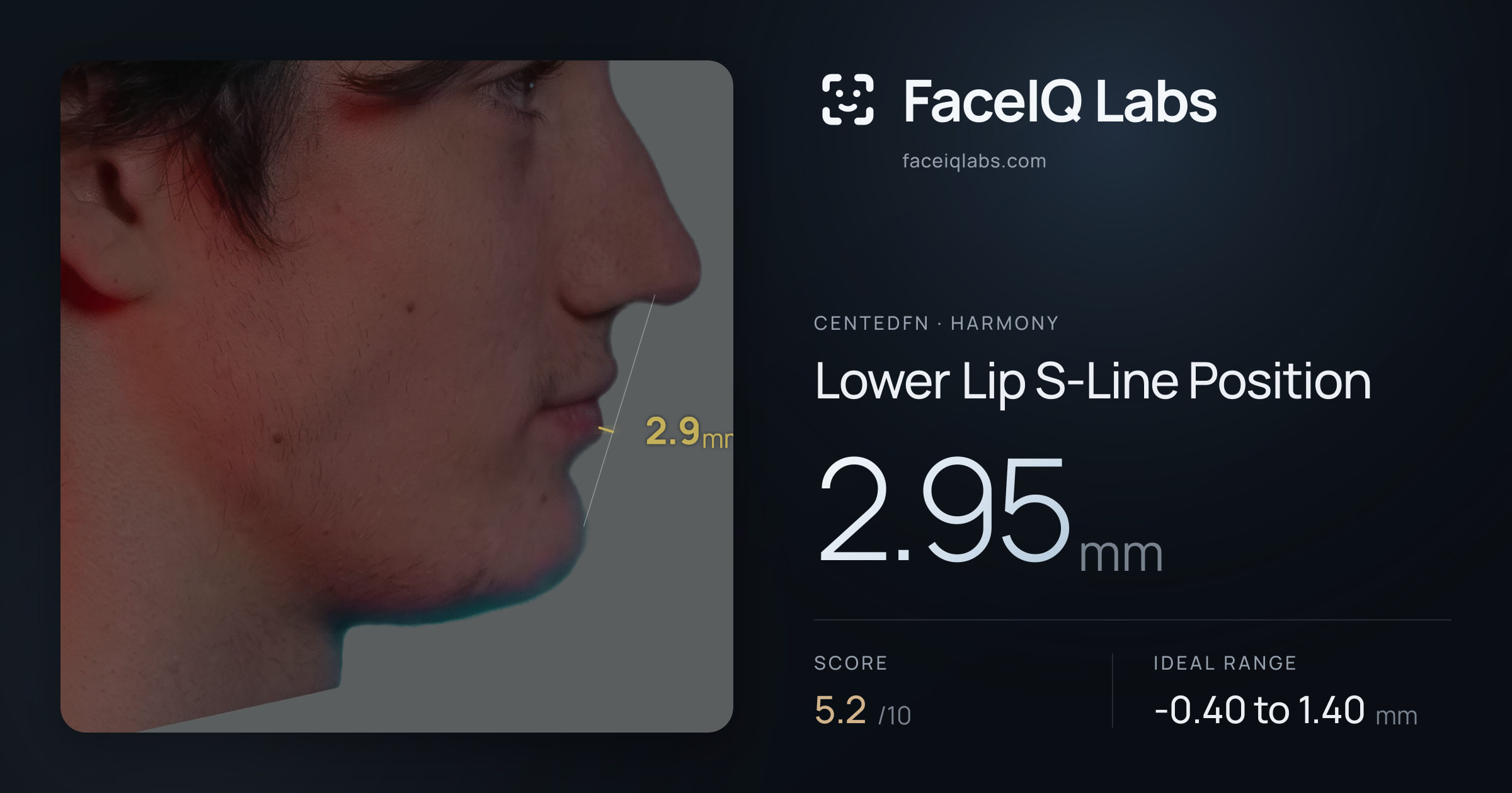 CentedFN Lower Lip S-Line Position: 2.95mm, drawn on the photo