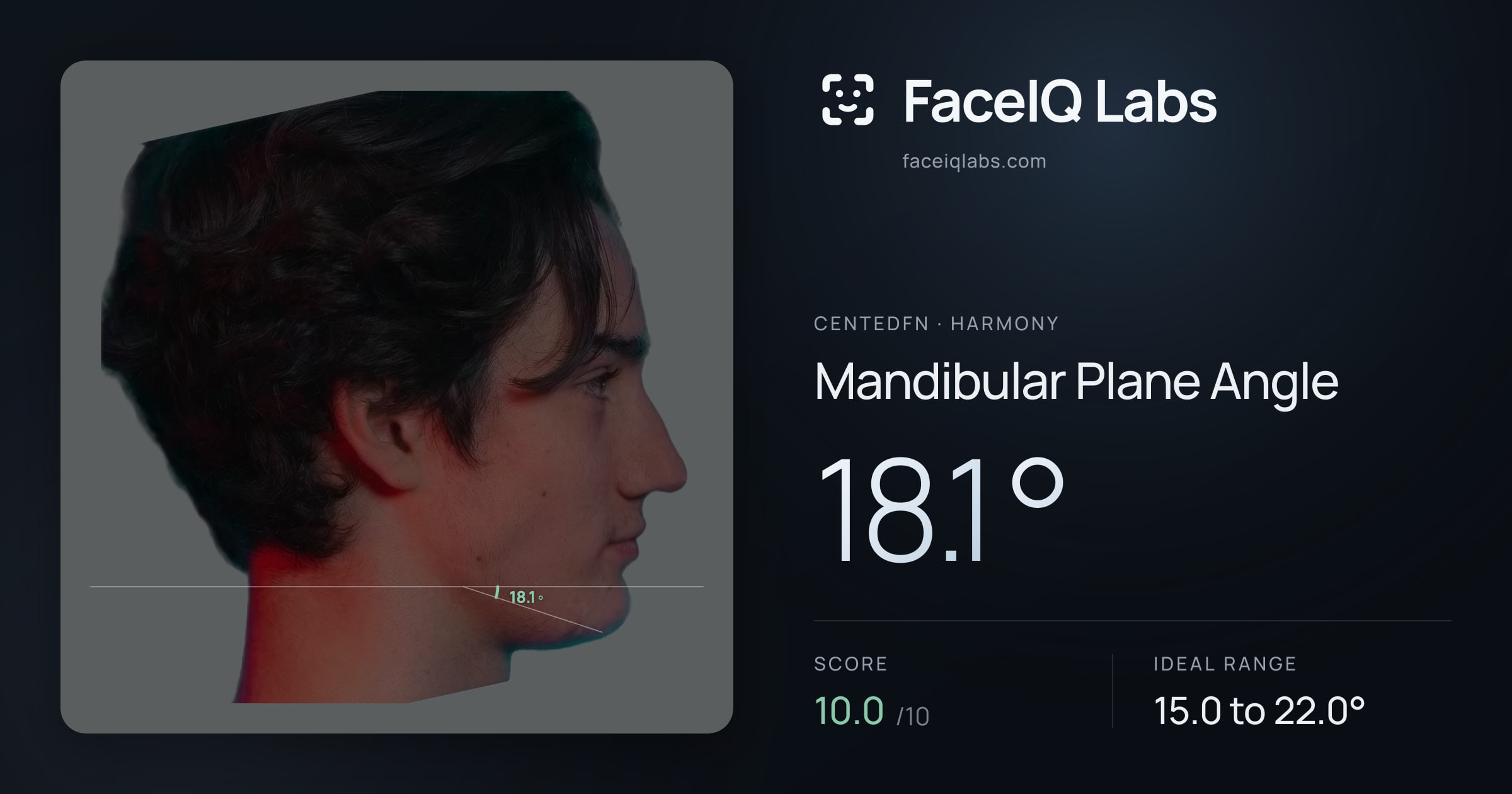 CentedFN Mandibular Plane Angle: 18.1°, drawn on the photo