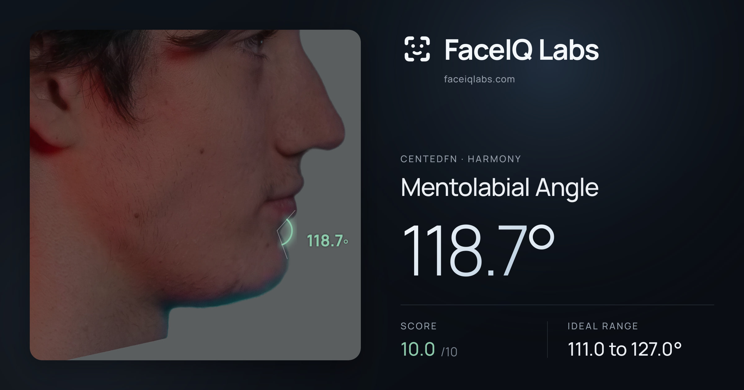 CentedFN Mentolabial Angle: 118.7°, drawn on the photo